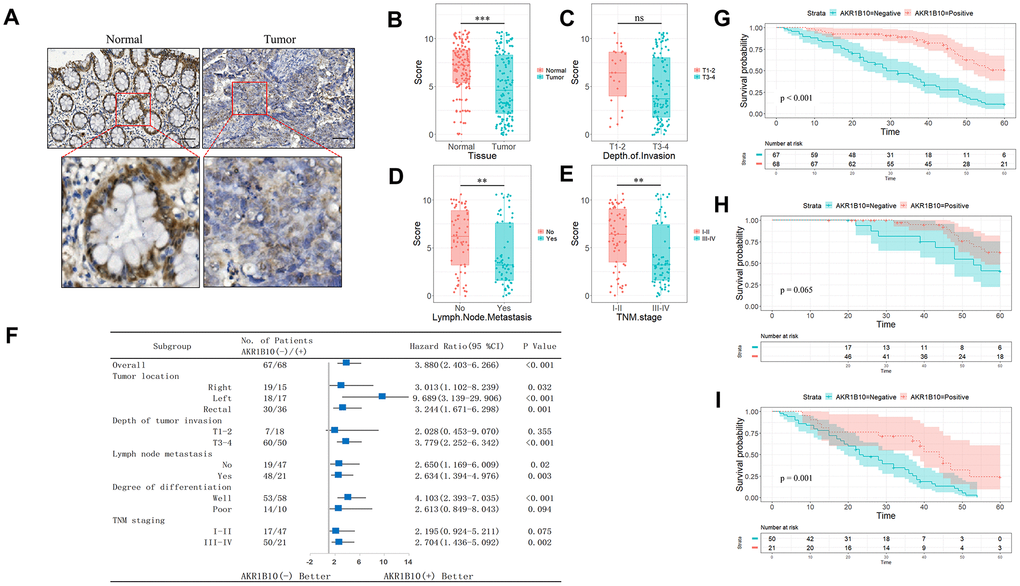 Expression of AKR1B10 in CRC tissues. (A) Representative IHC images showing in situ AKR1B10 expression in CRC and normal tissues (scale bar = 100μm). (B–E) IHC scores of AKR1B10 in (B) CRC vs normal tissues, (C) T I-II vs T III-IV tissues, (D) tumors with or without lymph node invasion, and (E) early vs late TNM staging. (F) OS of AKR1B10pos and AKRiB10neg CRC patients in subgroups demarcated by tumor location, depth of tumor invasion, lymph node metastasis, degree of differentiation and TNM staging. (G–I) OS of (G) AKR1B10pos and AKRiB10neg CRC patients with TNM staging I-II (H) and III-IV (I). CRC, colorectal cancer. OS, overall survival. ns, no significant difference. ** P 