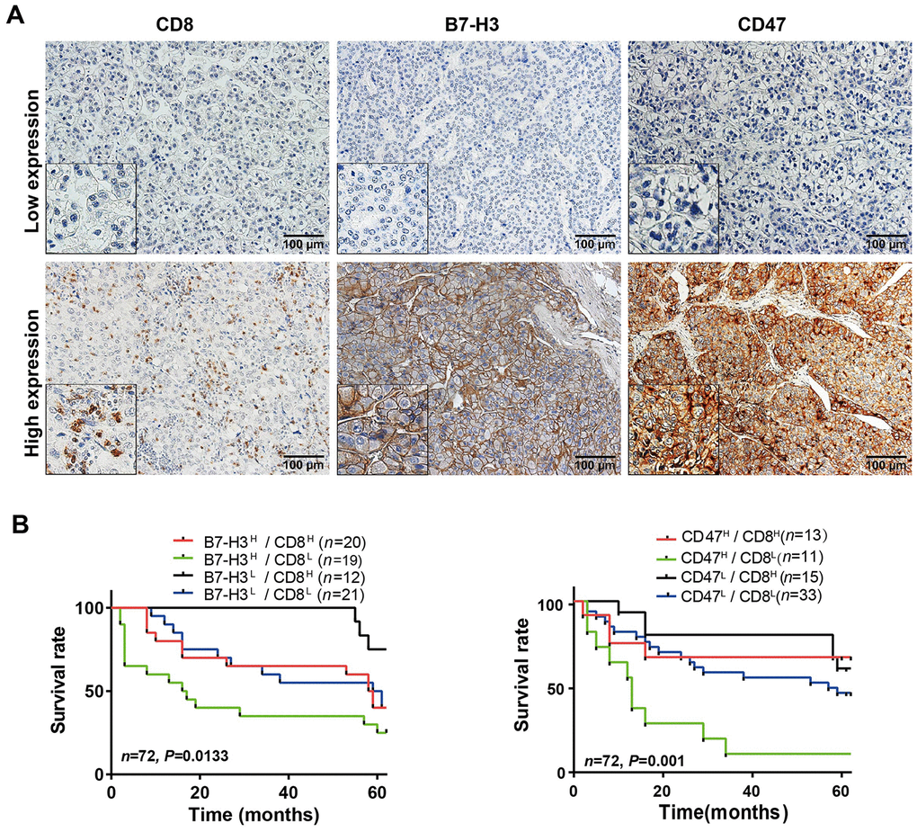 Parallel analysis of the effect of B7-H3, CD47 and CD8 on survival of HCC patients in the SYSUCC cohort. (A) Representative images of high and low expression of CD8, B7-H3 and CD47 detected by IHC in HCC tissues (Magnifications: 200× and 400x [the left-lower corner in the images]). (B) Survival curves of HCC patients stratified by combined expressions of B7-H3 and CD8 proteins: the survival of patients with B7-H3low/CD8high is significantly better than that of those with B7-H3high/CD8high (P = 0.043), B7-H3highCD8low (P = 0.003) or B7-H3low/CD8low (P = 0.048) and no significance between other groups. (C) Survival curves of HCC patients stratified by combined expression of CD47 and CD8 proteins: the survival of patients with CD47high/CD8low is significantly worse than that of those with CD47high/CD8high (P = 0.01), CD47lowCD8high (P low/CD8low (P = 0.003) and no significance between other groups. H represents high and L represents low respectively (log rank test).