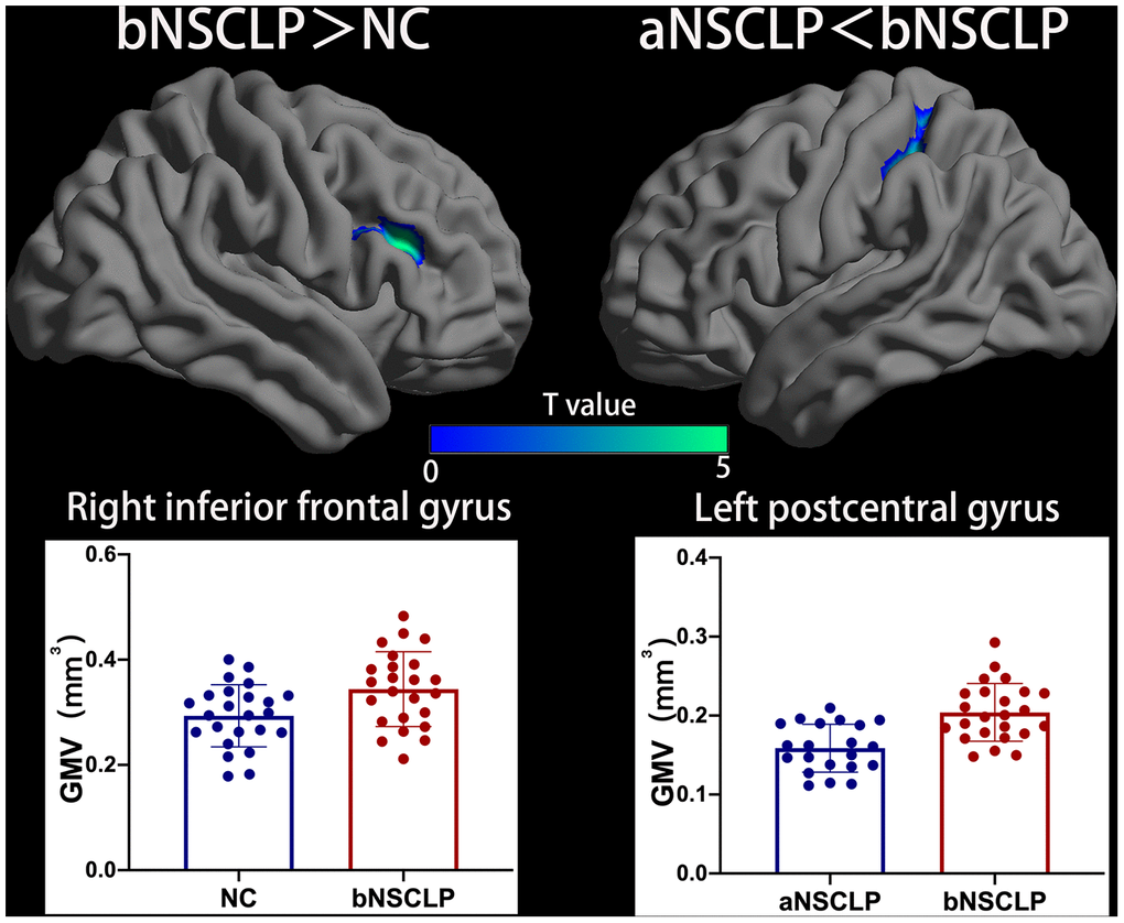 Increased gray matter volume (GMV) in bNSCLP compared with aNSCLP and controls. Voxel-based analysis showed that the bNSCLP group exhibited increased GMV in right IFG compared with controls. Besides, bNSCLP group had increased GMV in left PoCG compared with aNSCLP (P