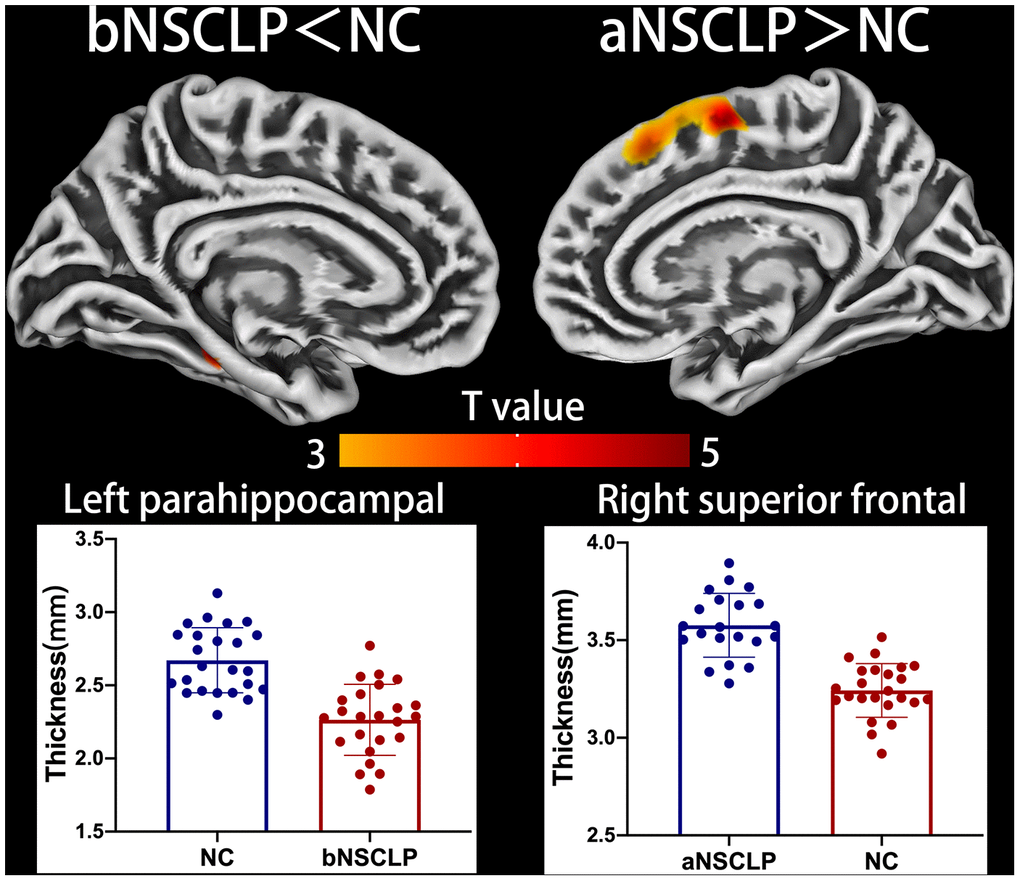 Altered cortical thickness between every pair in the three groups. Regions with intergroup differences are shown on lateral or medial views. Two-sample t-test for every pair in the three groups was used; statistical significance, P