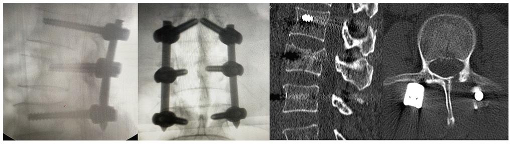 Postoperative X-rays and CT examination of the patient.