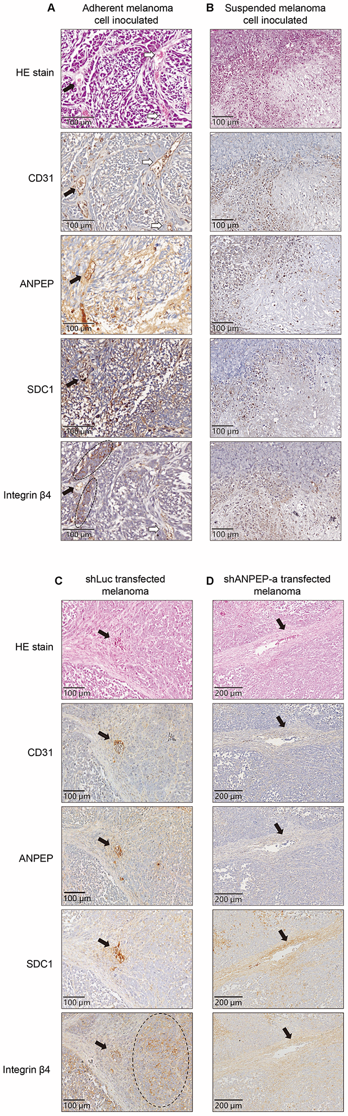 Immunostaining showed different vascular phenotypes with different protein expressions upon cell suspension and suppression of ANPEP expression. Photomagnification of tumor tissues derived from (A) adherent melanoma cells or (C) shLuc-transfected cells with HE stain and immunostaining of CD31 showed vascular structures. Positive ANPEP, SDC1, and integrin β4 expression in these tumor tissues were also presented. Filled arrow, vascular cavities with integrin β4-positive cells-surrounded. Empty arrow, vascular cavities with integrin β4-positive cells. No vascular structures with CD31/ANPEP/SDC1/integrin β4 expression were seen in those from (B) suspended melanoma cells or (D) shANPEP-transfected cells. The arrows indicated the locations of RBC-infiltrated cavities.