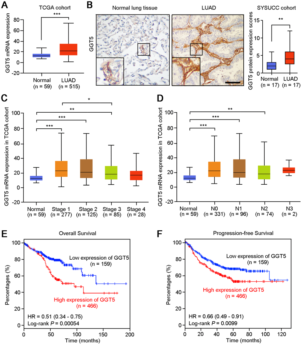 High expression of GGT5 is associated with the poor survival of patients with LUAD. (A) The mRNA expression of GGT5 in normal lung tissues (n = 59) and LUAD (n = 515) were analyzed using The Cancer Genome Atlas database (TCGA) cohort. (B) Immunohistochemical (IHC) staining showed the protein expression of GGT5 in normal lung and LUAD tissues. Scale bar, 200 μm. (C, D) GGT5 expression is related to cancer stages (C) and (D) lymphatic metastasis in LUAD. (E, F) High expression of GGT5 predicts the poor survival of patients with LUAD. Patients with high or low expression of GGT5 were distinguished based on ROC curve analysis, and the cutoff value of GGT5 expression value was set as 19. In panels (A–D), data represent mean ± SD. *, P P P 