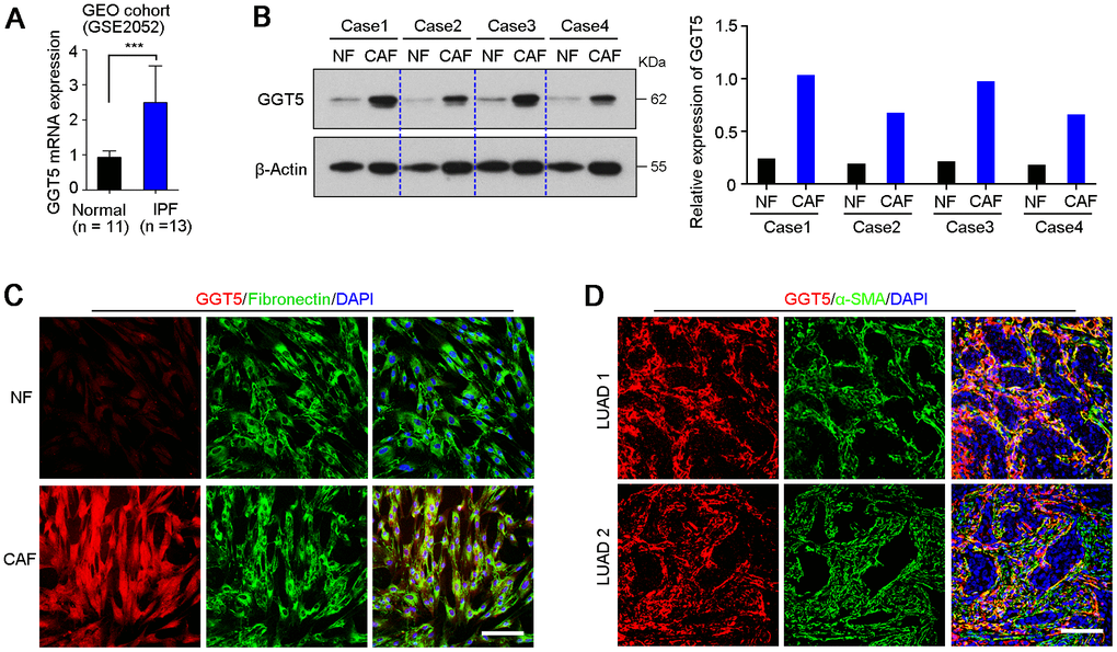 GGT5 is highly expressed in CAFs. (A) The expression level of GGT5 in normal lung tissues and lung tissues from patients with idiopathic pulmonary fibrosis (IPF) were analyzed using GEO public cohort (https://www.ncbi.nlm.nih.gov/geo/query/acc.cgi?acc=GSE2052). Data represent mean ± SD. ***, P B) Western blotting showed the high expression of GGT5 in CAFs than that in paired normal fibroblasts (NFs). β-Actin was also tested as a loading control. The relative expression of GGT5 was indicated in right panel based on the gray value of protein bands (ImageJ software). (C) The expression of GGT5 in NFs and CAFs in vitro were analyzed by immunofluorescent (IF) double-staining with antibodies against GGT5 (red) and Fibronectin (green, a marker of fibroblasts). Scale bare, 50 μm. (D) IF double-staining with antibodies against GGT5 (red) and α-SMA (green, a marker of CAFs) were performed on two LUAD tissue sections. Scale bar, 200 μm. In panels C and D, the cell nuclei were counterstained with DAPI (blue).