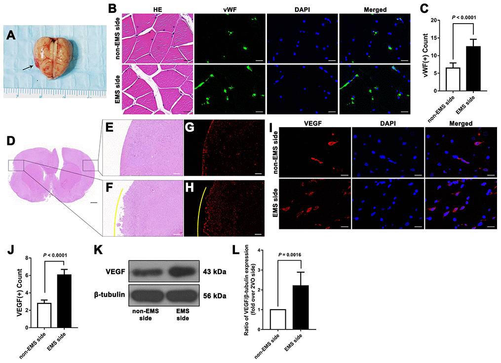 Effectiveness of the 2VO+EMS model in promoting EC proliferation determined by immunofluorescence and western blot assays. (A) Brain samples from 2VO+EMS rats (the black arrow indicates the adhered TM tissue). (B, C) Hematoxylin and eosin (HE) and immunofluorescence results showing that there was a significantly higher number of vWF(+) cells in the TM tissue on the EMS side than on the non-EMS side. Bar = 20 μm. (D) HE-stained slide of a brain from a 2VO+EMS rat. The two black frames indicate the portion of the brain tissue in contact with the TM and the brain tissue on the symmetrical part of the 2VO side. Bar = 1 mm. Enlarged image of the black frame on (E) the non-EMS side and (F) the EMS side. Bar = 200 μm. VEGF(+) immunofluorescence results for (G) the non-EMS side and (H) the EMS side. Bar = 200 μm. The yellow curve indicates the brain surface involved in EMS. Immunofluorescence (I, J) and western blot (K, L) results showing that there was significantly higher VEGF expression on the EMS side in the 2VO+EMS rat brains than on the non-EMS side. Bar = 20 μm. The error bars represent the ±SDs. VEGF: vascular endothelial growth factor; EMS: encephalo-myo-synangiosis; EC: endothelial cell; vWF: von Willebrand factor.