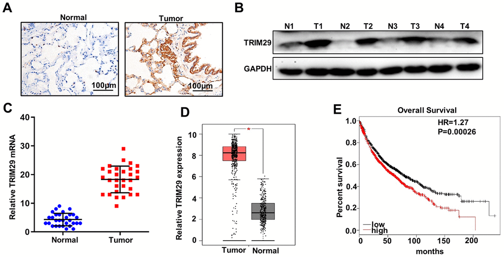 TRIM29 gene is highly expressed in lung squamous cell carcinoma tissues. (A) Immunohistochemical analysis of normal tissues and lung squamous cell carcinoma tissues. (B) Western blot analysis of normal tissues and lung squamous cell carcinoma tissues. N: normal tissues; T: tumor tissues. GAPDH was employed as an internal reference. (C) qRT-PCR analysis the TRIM29 mRNA abundance in 30 lung squamous cell carcinoma tissues and paired normal tissues. (D) mRNA abundance analysis of TRIM29 gene in GEPIA database (http://gepia.cancer-pku.cn/index.html). (E) Validate the relationship between the expression of TRIM29 in lung squamous cell carcinoma and survival in Kaplan-Meier Plotter database (http://www.kmplot.com/). *P