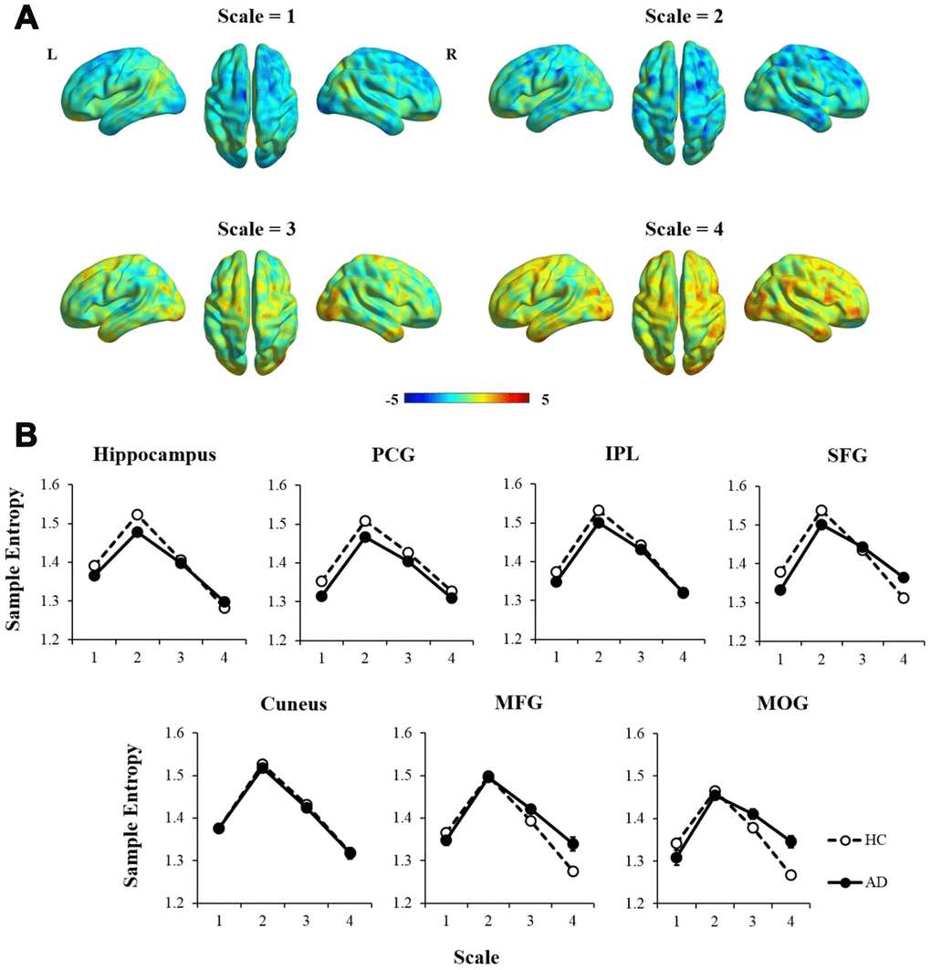 The comparison of MSE patterns between AD and HC in different time scales using independent two-sample t-test, controlled for age, education, head motion, and GM. (A) In scale = 1 and 2, most of the brain regions showed decreased entropy in AD compared with HC. In scale = 3 and 4, the statistical maps tended to show reversed patterns of MSE. (B) MSE of each region was extracted and showed significant interaction effects of group × scale in the hippocampus, SFG, MFG, and MOG (p 