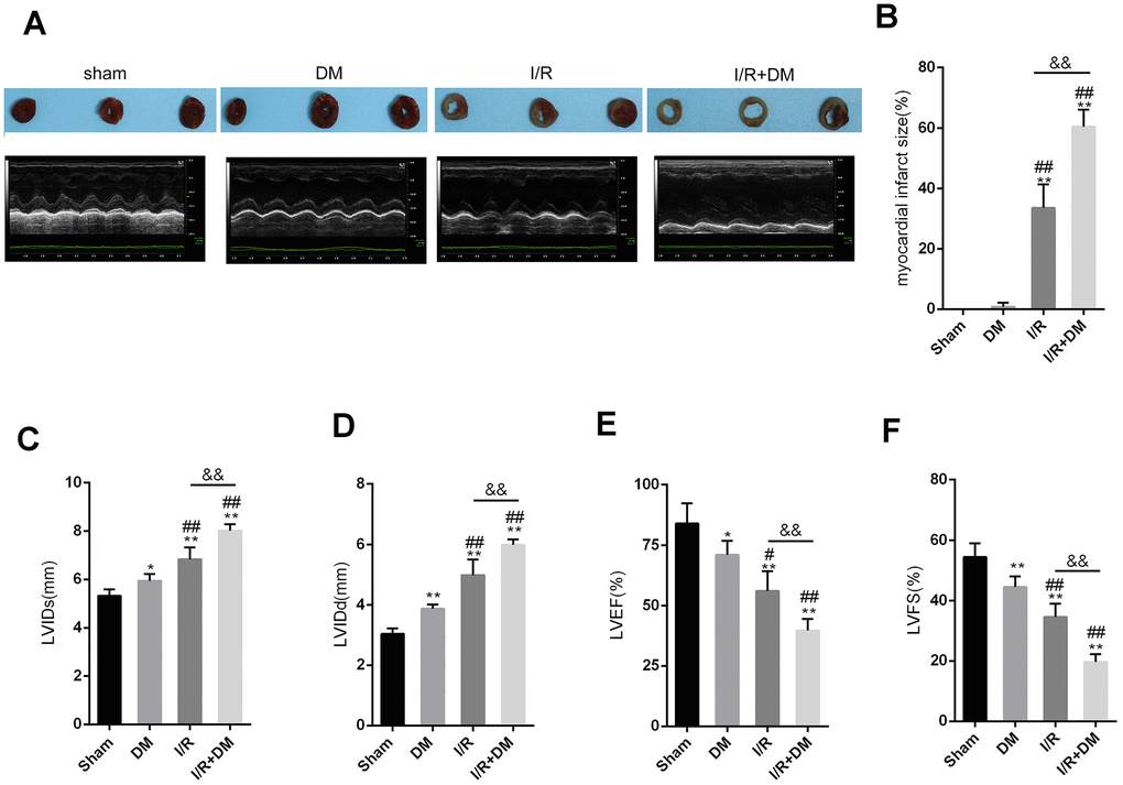 Myocardial ischemia reperfusion (I/R) injury model in diabetes mellitus (DM) rats SD rats were subjected to DM induction and then received coronary artery ligation to induce myocardial infarction (MI). Rats were randomly assigned to three groups: sham surgery group, DM group, I/R group, and I/R + DM group. (A) Representative photos of myocardial infarct size. Four weeks after I/R operation, rats were then examined for (A, C, D, E, and F) LVIDs, LVIDd, LVEF, and LVFS by echocardiography; (B) myocardial infarct size. N=5. **PPPP