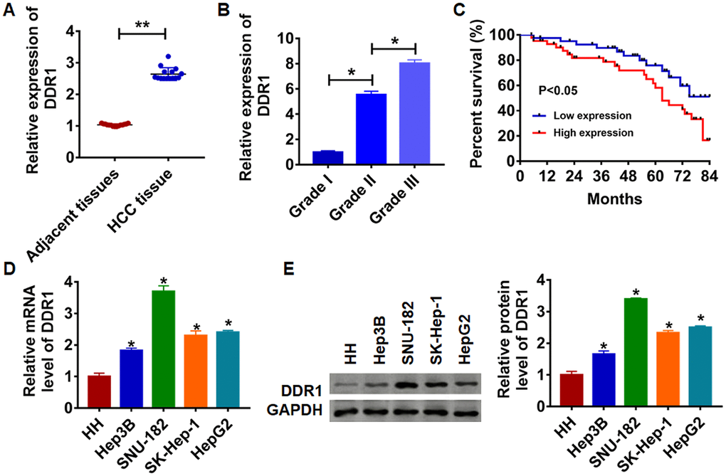 Expression of DDR1 in HCC tissue and cells. (A) The expression of DDR1 in clinical HCC tissues (n = 15) and adjacent normal tissues (n = 15) determined by qRT-PCR (**pB) Another HCC tissues from patients with tumor grade I (n = 8), grade II (n = 8) and grade III (n = 8) were collected, and the expression of DDR1 in was measured by qRT-PCR (*pC) The overall survival of HCC patients with low or high expression of DDR1 in HCC tissues were assessed by Kaplan-Meier survival analysis (n = 15, *pD) and western blot (E) analyzed the expression of DDR1 in human hepatocyte (HH) and HCC cell lines Hep3B, HepG2, SK-Hep-1 and SNU-182 (n = 6, *p