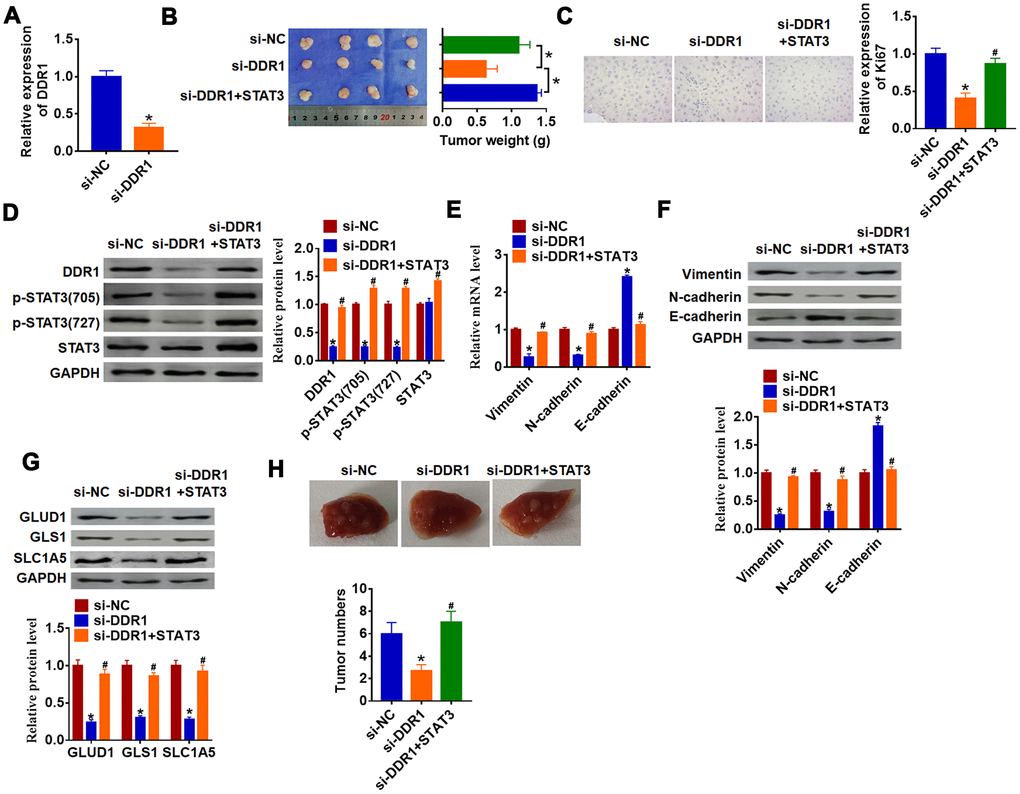 Downregulation of DDR1 inhibits HCC progression by regulating STAT3 in nude mice. Stable si-DDR1 or si-NC transfected SNU-182 cells were constructed (A) (n = 6, *pB) Tumor weight was determined in the isolated tumors from the nude mice (n = 4, *pC) Immunohistochemical staining of Ki67 used to determine cell proliferation (n = 4, *pvs si-NC, #pvs si-DDR1). (D) Western blot analyzed the protein level of DDR1, p-STAT3 and STAT3 in tumors (n = 4, *pvs si-NC, #pvs si-DDR1). qRT-PCR (E) and western blot (F) were used to test the expression of EMT related genes: Vimentin, N-cadherin and E-cadherin (n = 4, *pvs si-NC, #pvs si-DDR1). (G) The protein expression of glutamine metabolism related genes: GLUD1, GLS1 and SLC1A was determined by western blot (n = 4, *pvs si-NC, #pvs si-DDR1). (H) Stable si-DDR1 or si-NC transfected SNU-182 cells was intraperitoneally injected into mice, and lentivirus packaged STAT3 was injected into mice through tail vein 3 days later. Lungs were taken out and tumor numbers were calculated 4 weeks later.