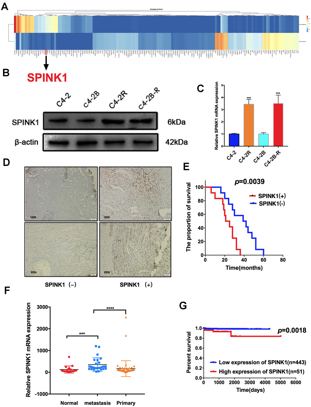 SPINK1 expression levels in Enz-resistant cells and metastatic PCa patients. (A) Differentially expressed genes (DEGs) between Enz-sensitive cell and Enz-resistant cell lines (≥ 5-fold and PB) Western blot showing high SPINK1 protein levels in C4-2R and C4-2B-R (C) RT-PCR results showing high SPINK1 mRNA levels in C4-2R and C4-2B-R. (D) Representative IHC images showing in situ SPINK1 expression in human PCa tissues. Positive SPINK1 expression was significantly associated with worse overall survival (p=0.0039, log-rank test, data from our hospital). (E) GDS2545 dataset results showing SPINK1 mRNA levels in the normal prostate tissues, and primary and metastatic prostate tumors. (F, G) Kaplan-Meier plot showing survival rate of SPINK1hi and SPINK1lo PCa patients in the TCGA dataset, SPINK1hi is associated with poor prognosis (p=0.0018).