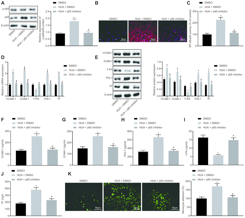 HUA stimulates the expression of thrombus-related factors and the adhesion of monocytes and platelets to HUVECs via NF-κB pathway activation. Normal HUVECs were treated DMSO, and HUA-treated HUVECs were treated with DMSO or p65 inhibitor. (A) p65 and phosphorylated p65 expression in HUVECs detected by western blot analysis normalized to β-actin. (B) Phosphorylated p65 expression in HUVECs detected by immunofluorescence (× 400). (C) NF-κB DNA activity in HUVECs detected by ELISA. (D) VCAM-1, ICAM-1, PAI-1, TF, and T-PA expression in HUVECs determined by RT-qPCR normalized to GAPDH. (E) VCAM-1, ICAM-1, PAI-1, TF, and T-PA expression in HUVECs determined by western blot analysis normalized to β-actin. (F) VCAM-1 level in HUVECs determined by ELISA. (G) ICAM-1 level in HUVECs determined by ELISA. (H) PAI-1 level in HUVECs determined by ELISA. (I) TF level in HUVECs determined by ELISA. (J) T-PA level in HUVECs determined by ELISA. (K) Adhesion of monocytes to HUVECs (× 200). * p vs. normal HUVECs treated with DMSO. # p vs. HUA HUVECs treated with DMSO. The measurement data were shown as mean ± standard deviation and compared by one-way analysis of variance, followed by Tukey's post hoc test. The cell experiment was repeated three times independently.