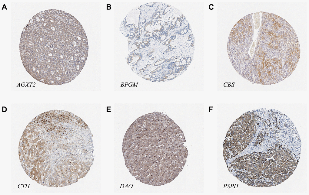 The protein levels of candidate metabolic enzyme genes in LIHC tissues. (A) AGXT2 (Antibody HPA037382). (B) BPGM (Antibody HPA016493). (C) CBS (Antibody HPA001223). (D) CTH (Antibody HPA001223). (E) DAO (Antibody HPA038653). (F) PSPH (Antibody HPA020376).