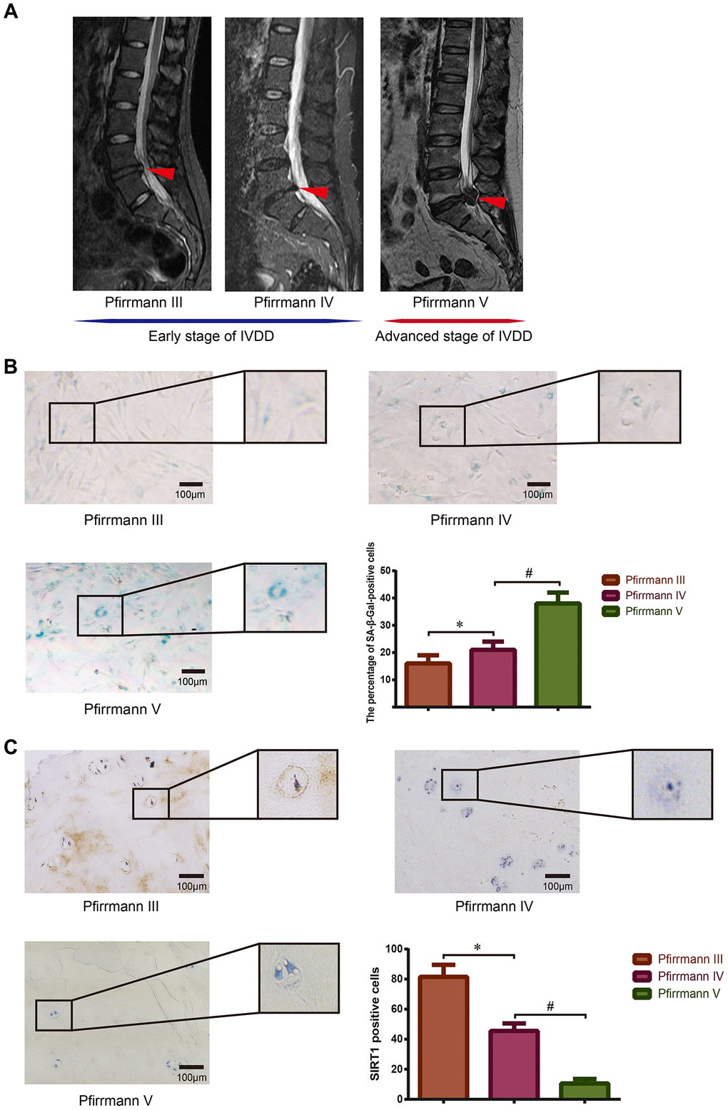 Detection of SIRT1 expression and cellular senescence in human degenerative NP tissues. (A) Preoperative lumbar MRI images of patients’ IVD tissues were classified via Pfirrmann’s grading system. Degenerative IVDs scored III-IV were defined as early stage of IVDD, and the discs scored V were defined as advanced stage of IVDD. Red arrows refer to the position of the acquired NP tissue. (B) The degree of senescence of NP cells isolated from IVDs with different grades of degeneration was detected and analyzed using SA-β-Gal staining (200×). (C) The expression level of SIRT1 in NP tissues obtained from patients with different Pfirrmann grades was detected by immunohistochemistry (200×). *P#P