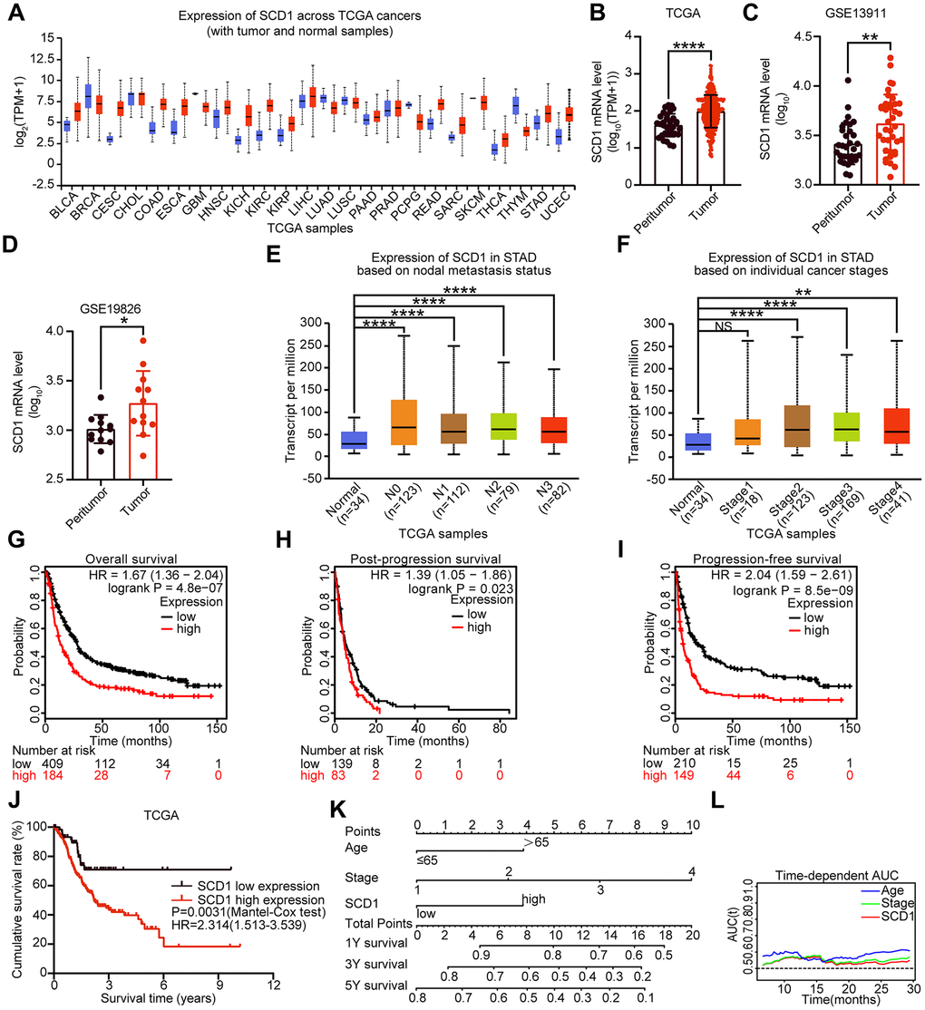 Expression level and prognostic value of SCD1 in various types of cancer. (A) SCD1 mRNA expression level in pan-cancer tissues and normal tissues. BLCA, bladder urothelial carcinoma; BRCA, breast invasive carcinoma; CESC, cervical squamous cell carcinoma and endocervical adenocarcinoma; CHOL, cholangio carcinoma; COAD, colon adenocarcinoma; ESCA, esophageal carcinoma; GBM, glioblastoma multiforme; HNSC, head and neck squamous cell carcinoma; KICH, kidney chromophobe; KIRC, kidney renal clear cell carcinoma; KIRP, kidney renal papillary cell carcinoma; LIHC, liver hepatocellular carcinoma; LUAD, lung adenocarcinoma; LUSC, lung squamous cell carcinoma; PAAD, pancreatic adenocarcinoma; PRAD, prostate adenocarcinoma; PCPG, pheochromocytoma and paraganglioma; READ, rectum adenocarcinoma; SARC, sarcoma; SKCM, skin cutaneous melanoma; THCA, thyroid carcinoma; THYM, thymoma; STAD, stomach adenocarcinoma; UCEC, uterine corpus endometrial carcinoma; (B) SCD1 mRNA expression were significantly overexpressed in gastric cancer tissues compared with peritumor tissues in TCGA database. (C, D) SCD1 mRNA expression were significantly overexpressed in gastric cancer tissues compared with normal ones in GSE13911 and GSE19826 database. (E) The mRNA expression level of SCD1 in different lymph node metastasis based on TCGA-STAD database. (F) The mRNA expression level of SCD1 in different AJCC stages based on TCGA-STAD database. (G) Overall survival of patients in SCD1-low expression group and SCD1-high expression group based on GEO database. (H) Post-progression survival of patients in SCD1-low expression group and SCD1-high expression group based on GEO database. (I) Progression-free survival of patients in SCD1-low expression group and SCD1-high expression group based on GEO database. The survival time of patients was compared between groups using the Mantel-Cox test. *, P P P P J) Overall survival of patients in SCD1-low expression group and SCD1-high expression group based on TCGA-STAD database. (K) Gastric cancer nomogram of overall survival for patients in TCGA-STAD database was examined by adding up of the points identified on the points scale for each characteristics. The total points existed on the bottom scales stand for the probability of 1-, 3- and 5- year survival. (L) Time-dependent area under the curve (AUC).