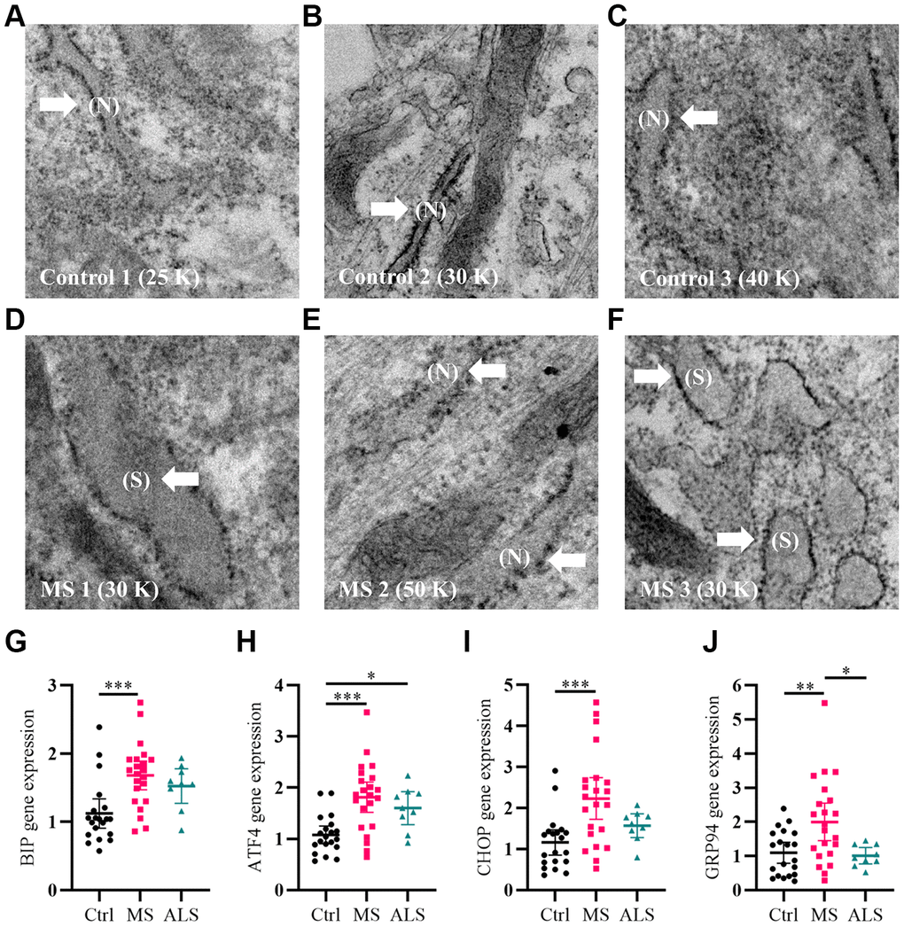 Signatures of ER stress are increased in MS skin fibroblasts. (A–F) Skin fibroblasts were imaged using electron microscopy. Representative images of three different skin fibroblasts from (A–C) control and (D–F) MS individuals are shown. Arrows point to (N, normal) or (S, swollen) ER. (G–J) Gene expression levels of BIP, ATF4, CHOP, and GRP94 were determined using RT-PCR. Detected gene expression levels were normalized to the reference gene β-actin. Each point represents a unique skin fibroblast (Ctrl, n = 20; MS, n = 22; ALS, n = 9). The average of replicates is shown with the 95% confidence interval. Significance between groups was determined using one-way ANOVA post hoc Tukey test. *, P 