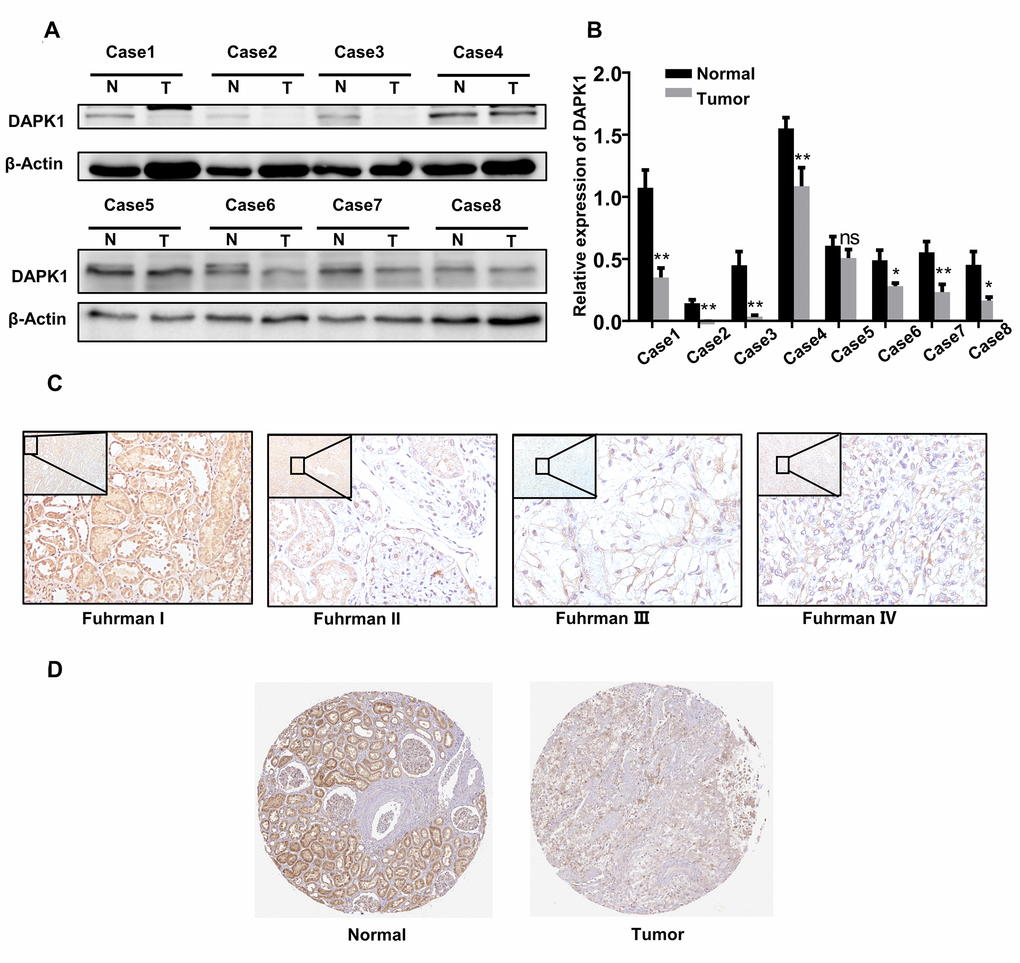 DAPK1 protein expression is reduced in advanced ccRCC patient tissues. (A, B) Western blotting and grayscale analysis results show DAPK1 protein expression in 8 pairs of ccRCC and adjacent normal kidney tissue samples. GAPDH is used as internal control. (C) Immunohistochemical (IHC) analysis shows DAPK1 protein expression in ccRCC tissues from patients with different Fuhrman stages. (D) IHC analysis shows DAPK1 protein expression in normal and ccRCC tissues based on IHC analysis in The Human Protein Atlas database.