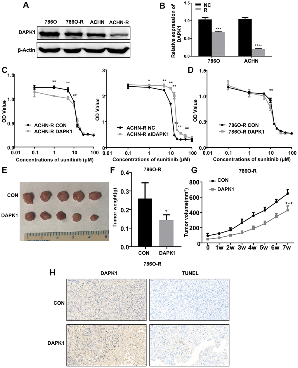 DAPK1 overexpression in the sunitinib-resistant ccRCC cells reduces the growth of xenograft tumors in the nude mice model. (A, B) Western blot analysis shows DAPK1 protein expression in parental (786-O and ACHN) and sunitinib-resistant (786O-R and ACHN-R) ccRCC cells. GAPDH is used as internal control. (C) CCK-8 assay results show the growth rate of control-ACHN-R, DAPK1-overexpressing ACHN-R, and DAPK1-knockdown ACHN-R cells that are treated with different concentrations of sunitinib. (D) CCK-8 assay results show the growth rate of control and DAPK1 overexpressing 786O-R cells that are treated with different concentrations of sunitinib. The picture (E), average weight (F) and volume (G) of the tumors obtained after 7 weeks of transplanting control and DAPK1 overexpressing 786O-R cells in the nude mice. (H) Immunohistochemical analysis of the xenograft tumors obtained by subcutaneously transplanting control and DAPK1 overexpressing 786O-R cells in nude mice. The bar graphs show the statistical analysis of three independent experiments. Note: The data are shown as means ± SEM. ***p