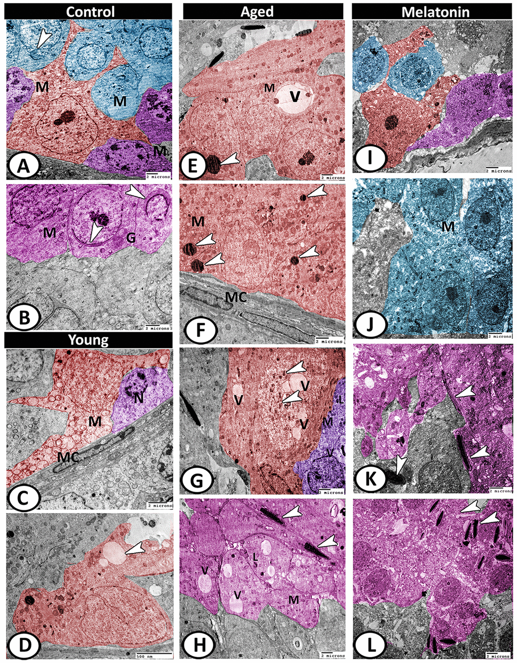 Digitally colored TEM image showing the ultrastructural changes in the seminiferous tubules of young and aged mice. (A) In the control group, the Sertoli cells (red) showed many cell processes and numerous mitochondria (M). Two spermatogonia populations (violet) were characterized by a network arrangement of nuclear chromatin and the cytoplasm contained mitochondria (M). The cytoplasm of primary spermatocytes (blue) was occupied by mitochondria (M)), and Golgi complex (arrowhead). (B) The spermatids (pink) characterized by the formation of an active acrosomal cap (arrowheads), presence of well-developed Golgi apparatus (G) and mitochondria (M). (C, D) In the young mutant mice, the Sertoli cells (red) showed degenerated mitochondria (M) and many vacuoles (arrowhead). The spermatogonia (violet) showed shrunken nuclei (N). Note, presence of myoid cells (MC) surrounding the seminiferous tubules. (E, F) In aged mice, the Sertoli cells' cytoplasm possessed vacuoles (V), mitochondrial metaplasia (M), lysosomes (arrowheads). Note, myoid cell (MC) showed no changes. (G) The cytoplasm of Sertoli cell (red) also contained phagocytosed materials (arrowheads) and vacuoles (V). The spermatogonia (violet) contained few mitochondria (M), vacuoles (V), and lysosomes (L). (H) The spermatids showed presence of many vacuoles (V), lysosomes (L), and the mitochondria (M) showed loss of their cristae. Many end pieces of degenerated sperms (arrowheads) could be demonstrated. (I) In melatonin group, the seminiferous tubules showed normal Sertoli cell (red), spermatogonia (violet) and spermatocytes (blue). (J) The spermatocytes (blue) contained numerous mitochondria (M) with some small vacuoles. (K, L) The differentiation of spermatids (pink) to normal sperms (arrowheads) was evident in melatonin group.