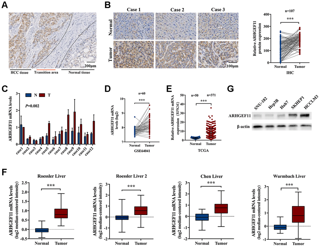 ARHGEF11 is upregulated in HCC tissues. (A) Representative IHC staining of ARHGEF11 in HCC tissues, scale bar 200 μm. (B) Three representative IHC staining images of ARHGEF11 in HCC and para-tumor tissues (left), scale bar 100 μm. Quantification of ARHGEF11 expression of paired HCC samples (n=107, right). Data are shown as mean ± SD. (C) Representative qRT-PCR results of ARHGEF11 expression of human HCC samples. Data are shown as mean ± SD. (D–F) Relative ARHGEF11 mRNA expression in GEO dataset (GSE64041), TCGA dataset and four Oncomine datasets respectively. (G) Relative ARHGEF11 expression in five hepatoma cell lines, as detected by western blot. ***P