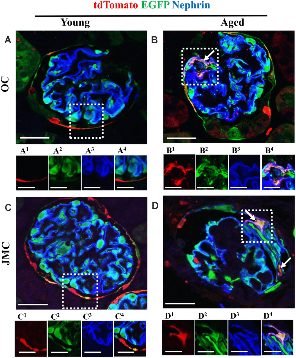 A subset of newly generated podocytes from PEC origin (tdTomato+EGFP+) co-express nephrin in the glomerular tuft of aged mice. (A–D) Representative confocal images of tdTomato staining (red fluorescent protein, RFP) (red), EGFP+ (green) and nephrin staining (blue) in young and aged mice. The inserts show separate channels of the outlined glomeruli, with superscripts: 1=tdTomato, 2=EGFP, 3=nephrin and 4=merged. (A) Young mice (OC) showed that tdTomato+PECs (red) were observed along Bowman’s capsule (A1) and genetically labeled podocytes (EGFP+ cells, green) (A2) co-express nephrin (blue) (A3), creating a cyan color (A4). (B) Aged mice (OC) showed that a subset of tdTomato+ PECs (labeled with red fluorescent anti-RFP) (B1) co-expresses EGFP+ (green) (B2) and nephrin (blue) (B3) creating a pink/yellow color in glomerular tuft (marked with white arrow) (B4). (C) Young mice (JMC) showed that tdTomato+ staining PECs were observed along Bowman’s capsule (C1) EGFP staining (C2) was detected in a typical podocyte distribution and overlaps with nephrin staining (C3), creating a cyan color (C4). (D) Aged mice (JMC) showed that tdTomato+ staining PECs (D1) (marked with white arrows) have migrated onto the glomerular tuft and differentiated to a podocyte fate, co-staining with EGFP (green) (D2) and nephrin (blue) (D3) creating pink/yellow color (D4). Scale bars represent 25μm or 5μm (insets).