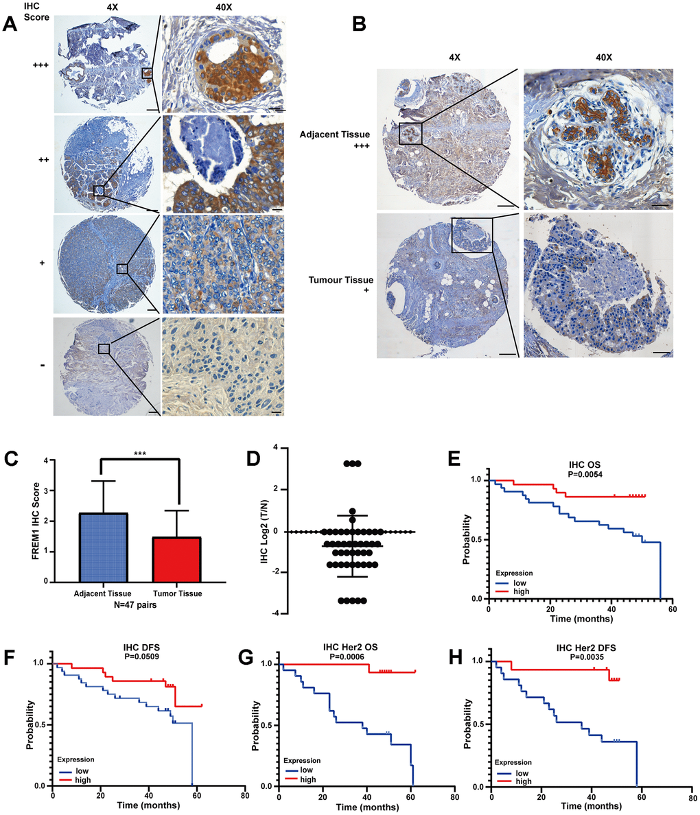 FREM1 expression is reduced in tumor tissues, which is associated with poor survival. (A) Representative IHC staining of FREM1 in human primary tumor and adjacent non-tumor tissue. Magnifications: 4X; boxed area is 40X. Scale bar: 4X, 200 μm; 40X, 20 μm. (B) FREM1 level is higher in adjacent tissues than in tumor tissues. Magnifications: 4X; and boxed area is 40X. Scale bar: 4X, 200 μm; 40X, 20 μm. (C, D) Analysis of FREM1 IHC staining scores in adjacent non-tumor (n = 48) and tumor tissue (n = 56). (*P P P E–H) Survival curves of OS and DFS in breast cancer and HER2 with low and high FREM1 expression. Median survival time of the high-expression group versus low-expression group.