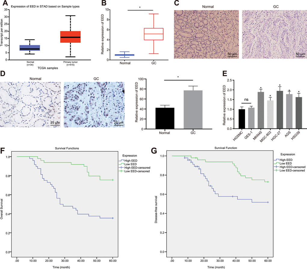 EED is highly expressed in GC tissues and cells. (A) Absolute EED expression in GC obtained by UALCAN database (http://ualcan.path.uab.edu/index.html). The blue box on the left represents the expression of normal samples, and the red box on the right represents the expression of GC samples. (B) RT-qPCR determination of EED expression in GC tissues and adjacent normal tissues (n = 97). (C) Representative images of GC tissues and adjacent normal tissues by HE staining. (D) Immunohistochemistry to assess the EED expression in GC tissues and adjacent normal tissues. (E) RT-qPCR to examine EED expression in GC cell lines and normal gastric cell lines, with β-actin as internal control. (F, G) Kaplan-Meier method with log-rank test to assess overall survival (F) and disease-free survival (G) of patients with relatively higher or lower EED expression (n = 97). Measurement data are expressed as mean ± standard deviation. * p t test, n = 97. Data comparison among multiple groups was performed using one-way ANOVA with Tukey's post hoc test. Kaplan-Meier method was carried out to investigate the relationship between high and low expression of EDD in GC tissues and overall survival and disease-free survival (log-rank test). Cell experiments were repeated 3 times independently.