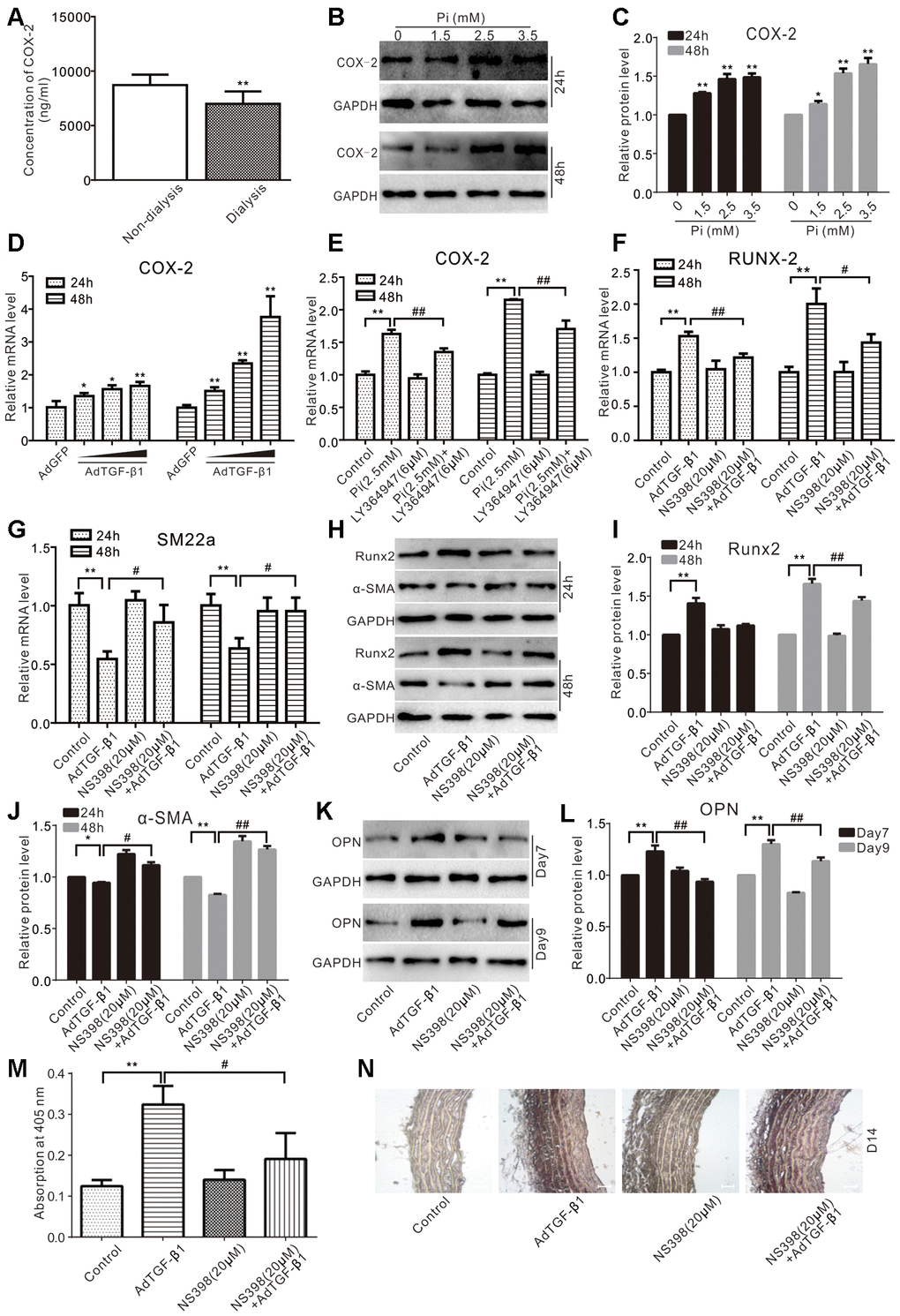 Effects of COX-2 on high phosphate and/or TGF-β1 induced calcification in VSMCs. (A) ELISA analysis results show the serum level of COX-2 in CKD patients treated with regular dialysis or non-dialysis (n=48) ("**" pB) Western blot assay results show the effect of high phosphate on COX-2 in VSMCs cells; GAPDH was used as a loading control. (C) Quantitative results of Western blot assay show the effect of high phosphate on COX-2 in VSMCs cells ("*" pD) Real-time PCR assay results show the effect of TGF-β1 on mRNA expression of Cox-2 in VSMCs cells ("*" pE) Real-time PCR assay results show the effect of high phosphate and/or LY364947 on mRNA expression of Cox-2 in VSMCs cells ("**" pF) Real-time PCR assay results show the effect of TGF-β1 and/or NS398 on expression mRNA of Runx-2 in VSMCs cells ("**" pG) Real-time PCR assay results show the effect of TGF-β1 and/or NS398 on mRNA expression of SM22α in VSMCs cells ("**" pH) Western blot assay results show the effect of TGF-β1 and/or NS398 on Runx2 and α-SMA in VSMCs cells, GAPDH was used as a loading control. (I) Quantitative results of Western blot assay show the effect of TGF-β1 and/or NS398 on Runx2 in VSMCs cells ("**" pJ) Quantitative results of Western blot assay show the effect of TGF-β1 and/or NS398 on α-SMA in VSMCs cells ("*" pK) Western blot assay results show the effect of TGF-β1 and/or NS398 on OPN in VSMCs cells; GAPDH was used as a loading control. (L) Quantitative results of Western blot assay show the effect of TGF-β1 and/or NS398 on OPN in VSMCs cells ("**" pM) Quantitative analysis results of Alizarin Red S staining show the effect of TGF-β1 and/or NS398 on mineralization in VSMCs ("**" pN) The Von Kossa staining results show the effect of TGF-β1 and/or NS398 on calcification in aortic segments (Scale=100 μM). Pi: phosphate, LY364947: TGFβRI-specific inhibitor, NS398: COX-2-specific inhibitor.