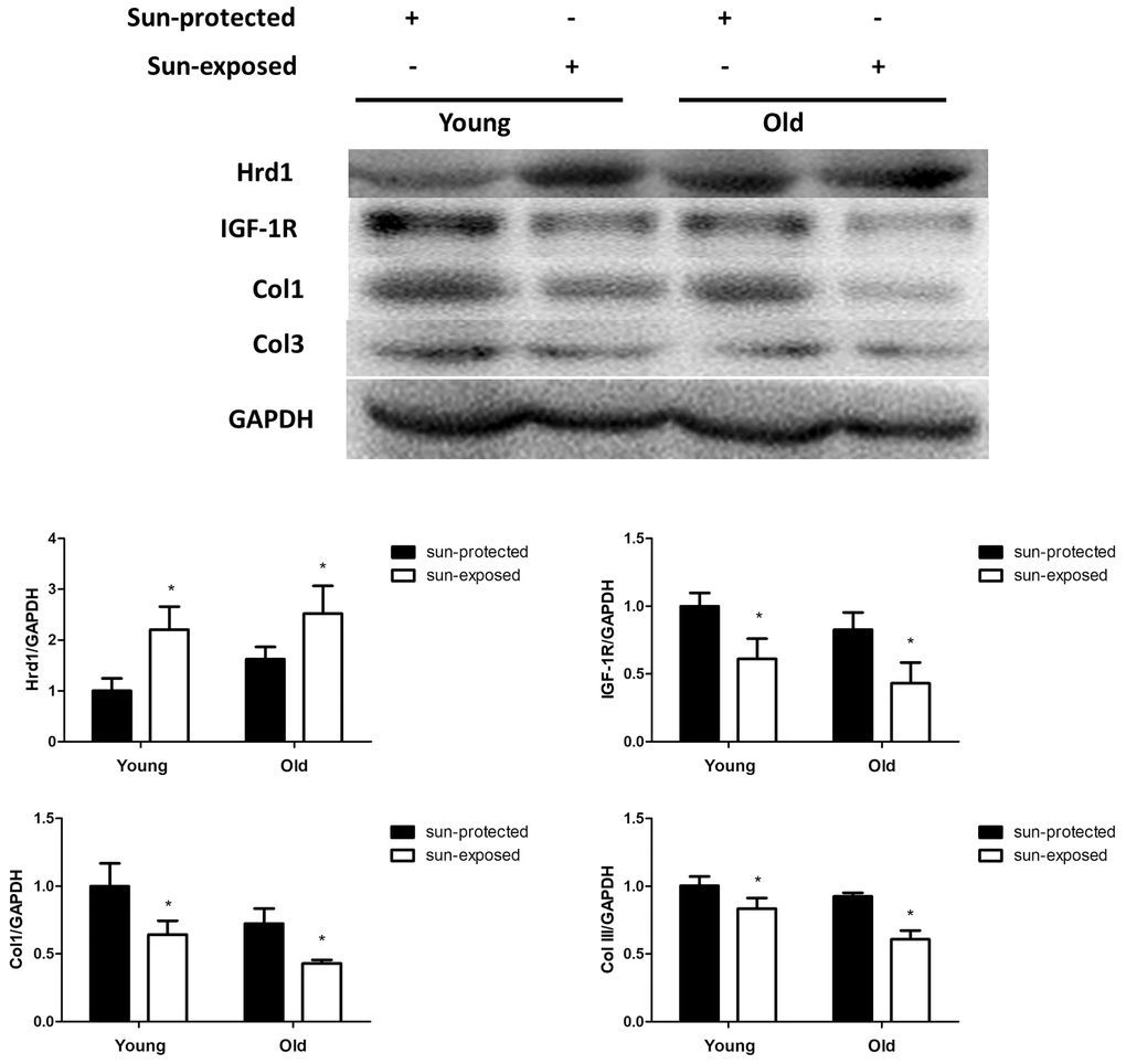 The expressions of Hrd1, IGF-1R, Type I collagen and Type III collagen by western blot in clinical samples. *P 