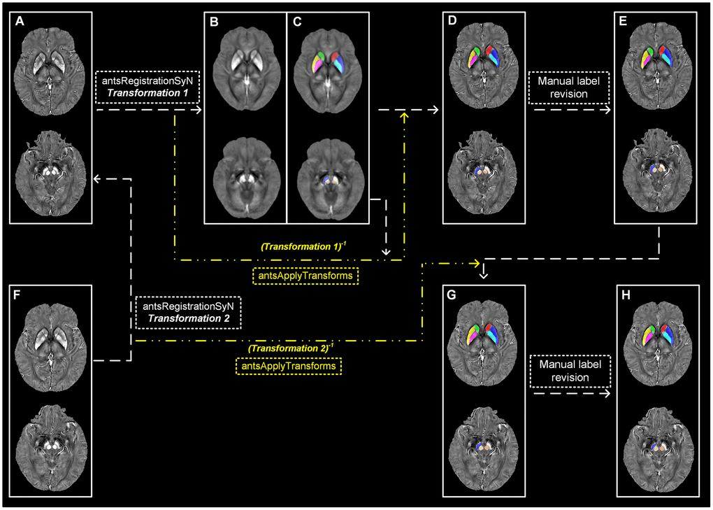 Semi-automatic extraction of regional tissue susceptibility. (A) Native QSM image at baseline; (B, C) QSM template ant the subcortical label in its space; (D) Warped subcortical label in the native QSM image at baseline; (E) Final label in the data analysis through manual revision; (F) Native QSM image at follow-up; (G) Warped subcortical label in the native QSM image at follow-up; (H) Final label in the longitudinal data analysis through manual revision. ANTs-SyN algorithms are used to complete the image coregistrations. QSM = Quantitative susceptibility mapping.