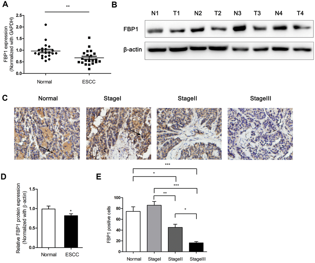 Down-regulated expression of FBP1 was determined in ESCC tissues. (A) Changes in FBP1 expression between ESCC tissues and adjacent non-ESCC tissues. (B, D) FBP1 protein expression and quantification were determined between ESCC tissues (T) and adjacent non-ESCC tissues (N). (C, E) Immunohistochemical analysis and quantification of FBP1 staining (200×) were performed in adjacent non-ESCC tissues and different TNM stage of ESCC according to the latest American Journal of Critical Care (AJCC) guide. *p