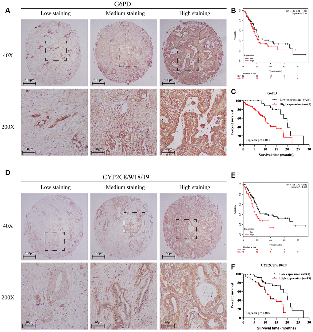 Verification of the effects of the pentose phosphate pathway and linoleic acid metabolism in PC using a tissue microarray. (A, D) IHC staining of a tissue microarray containing 83 PC patients with the G6PD antibody (A) or CYP2C8/9/18/19 (D) antibody. Intensity was classified as 0, 1+, 2+, and 3+, denoting no, weak, moderate, and strong staining, respectively. The distribution of staining was referred to as the percentage of positive tumor cells (0% to 100%). (B, E) Kaplan–Meier curves for overall survival of PC patients with different expression levels of G6PD (B) and CYP2C8/9/18/19 (E) according to the TCGA-PAAD mRNA-seq dataset. Black line represented low expression group and red line represented high expression group. (C, F) Kaplan–Meier curves for overall survival of PC patients with different expression levels of G6PD (C) and CYP2C8/9/18/19 (F) according to the IHC results of the tissue microarray containing 83 PC patients. The final G6PD and CYP2C8/9/18/19 expression scores were obtained by multiplying the two variables, intensity and distribution of staining. All samples were further divided into a low expression group and a high expression group according to the expression scores of G6PD (C) and CYP2C8/9/18/19 (F). Black line represented low expression group and red line represented high expression group.