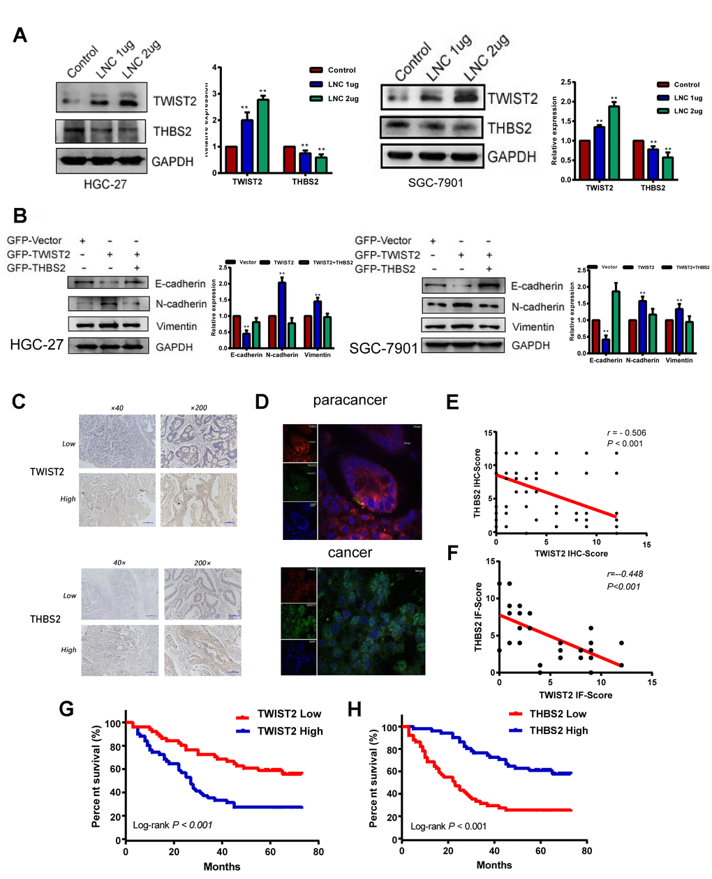 THBS2 is the apparent target gene of the LINC01235–TWIST2 axis. (A) The protein levels of TWIST2 and THBS2 were diminished by ectopic transfection of cells with strengthened LINC01235. (B) Western blot analysis of expression of E-cadherin, N-cadherin, and vimentin proteins in HGC-27 and SGC-7901 cells transfected with GFP-vector, GFP-TWIST2, and GFP-TWIST2/THBS2. (C) Low and high expression of TWIST2 and THBS2 in GC specimens. (D) TWIST2 and THBS2 expression by immunofluorescence staining in cancer and adjacent normal tissues. Green indicatesTWIST2, and red indicates THBS2. (E and F) Correlation between TWIST2 and THBS2 IHC scores and immunofluorescence scores. Kaplan–Meier analysis showed that (G) high expression of TWIST2 and (H) low expression of THBS2 predicted poor prognosis for GC patients.