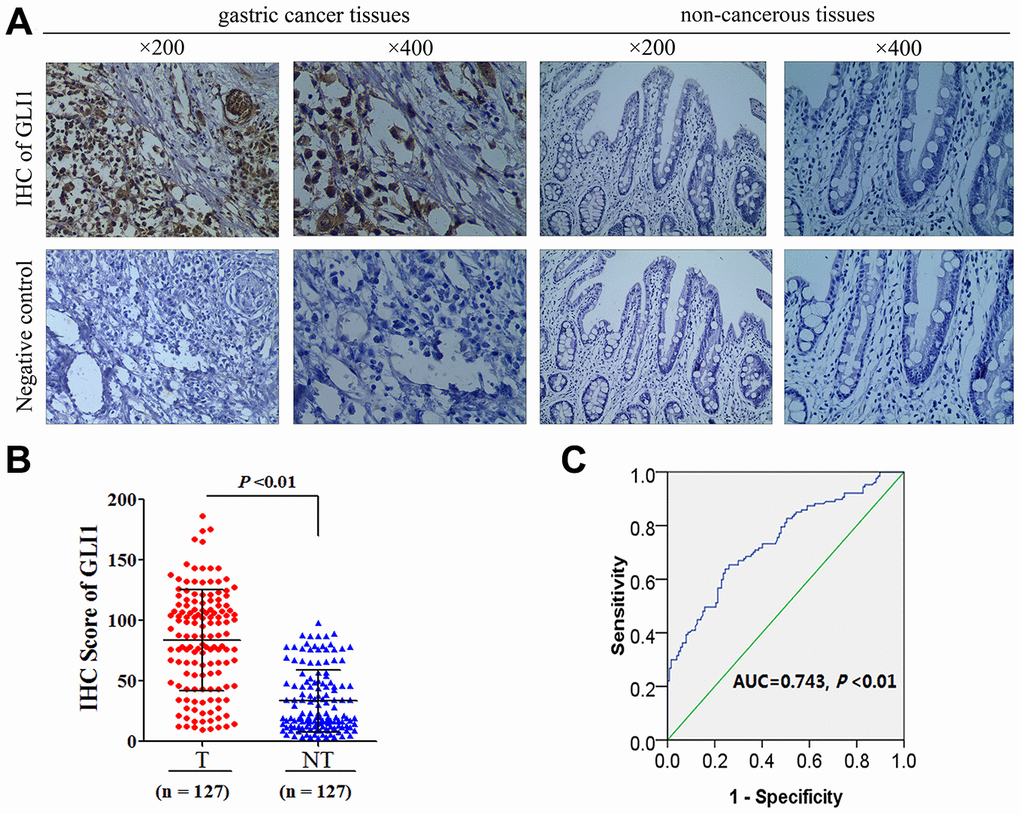 GLI1 is overexpressed in GC tissues (A) Representative images of IHC for GLI1 protein expression in GC tissues and matched non-tumor tissues. (B) GLI1 IHC scoring compared between tumor and matched non-tumor tissues. (C) ROC statistics were employed to estimate the cut-off points of GLI1 IHC scoring in human GC tissue.