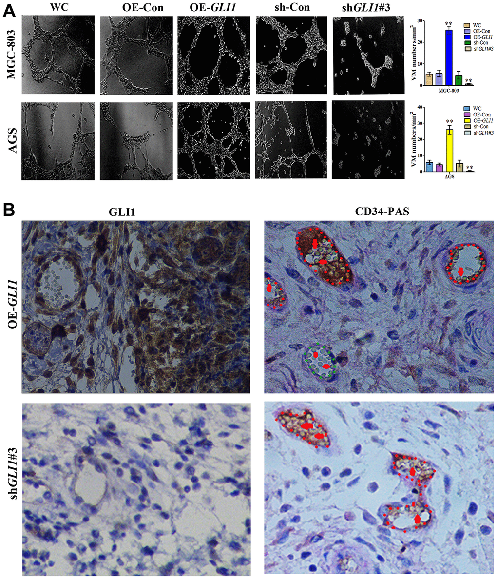 GLI1 promotes VM in vivo and in vitro. (A) Matrigel three-dimensional culture showing that GLI1 overexpression enhanced tube formation in MGC-803 and AGS cells, while silencing of GLI1 in MGC-803 and AGS cells inhibited their ability to form tube-like structures (×40 magnification; n = 3). (B) Expression of GLI1 and the formation of VM structures in the OE-GLI1 and sh-GLI1 subcutaneous GC mouse groups detected by IHC and CD34/PAS double staining. VM was significantly increased in the OE-GLI1 group, and was absent in the shGLI1#3 group (endogenous cell-dependent vessels are indicated by the red dotted line, VM is indicated by the green dotted line, and red blood cells are indicated by red arrows in VM and endogenous cell-dependent vessels; ×400 magnification).