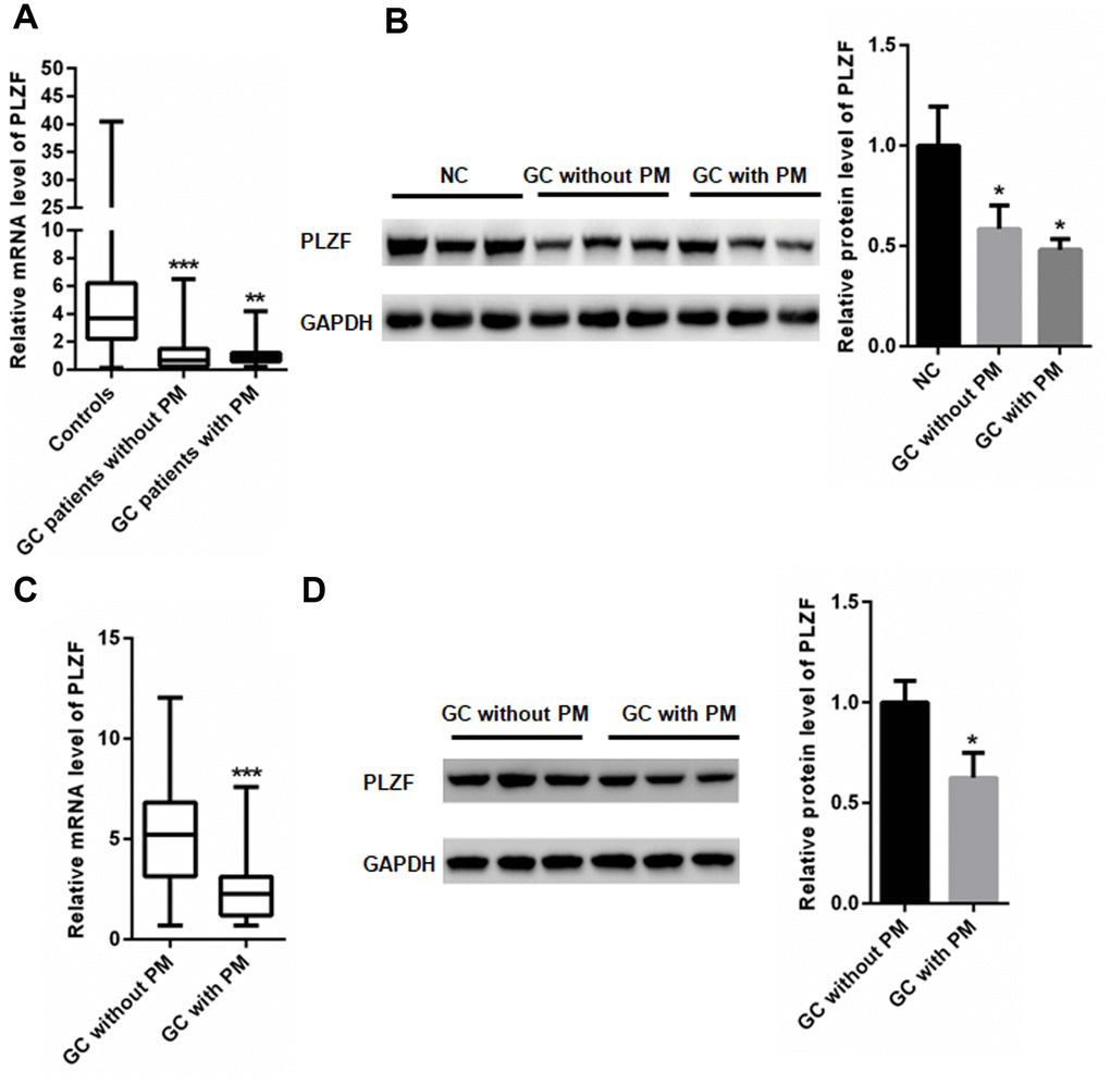 PLZF mRNA and protein levels in GC patients. (A) mRNA and (B) protein expression of PLZF in GC, and control adjacent tissues. (C) mRNA and (D) protein expression of PLZF in PM lesions and control tissues of GC patients. (n=68 for GC patients without PM, n=65 for GC patients with PM, one way ANOVA for A, B, two-tailed unpaired student’s t-tests for C, D).