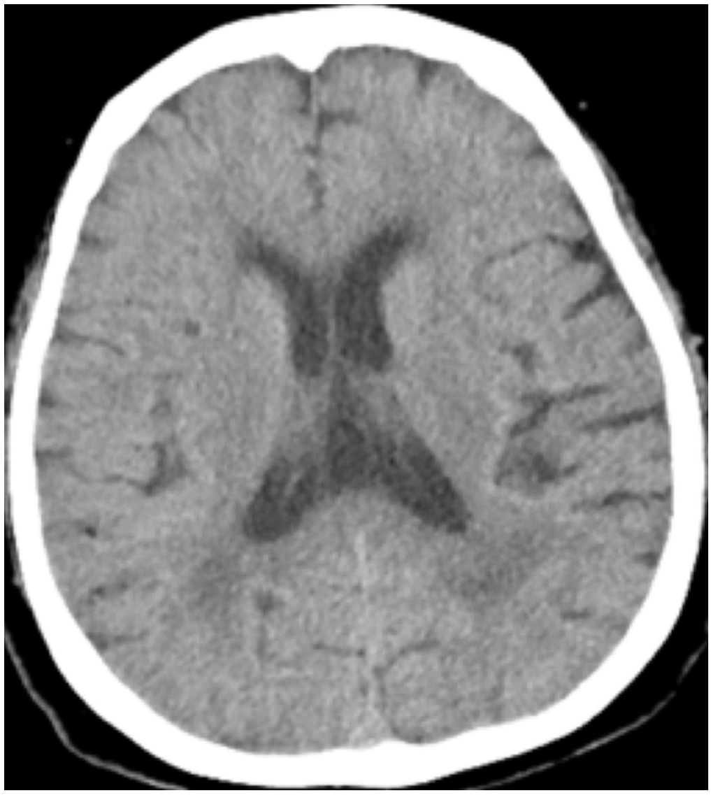 Case 11 point-like low density shadow in basal ganglia.