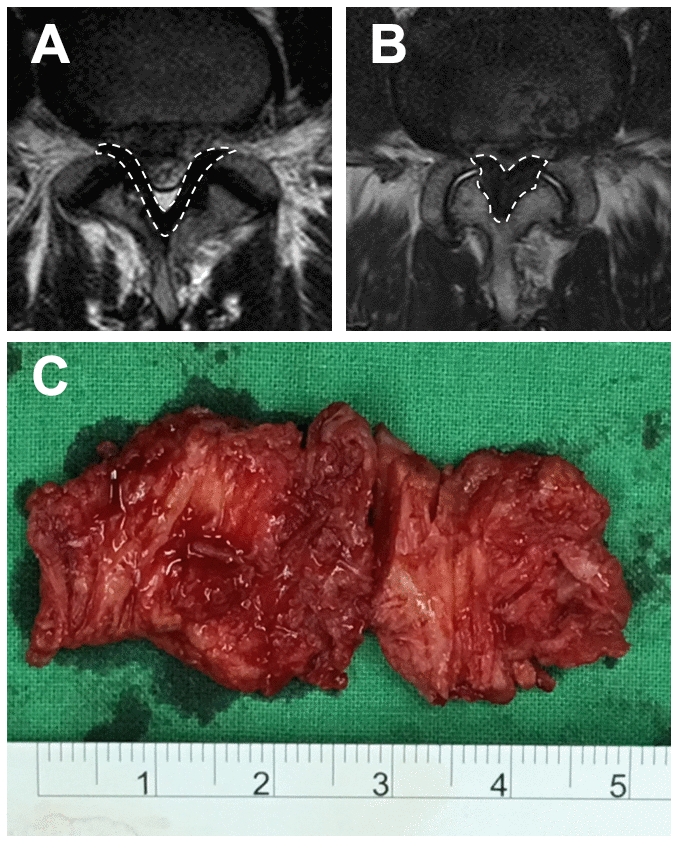 MRI image and the LF specimen. The T2-weighted image of the LF, surrounded by broken lines, at the L4/5 level of (A) an LDH patient and (B) an LSS patient. (C) A hypertrophic LF specimen.