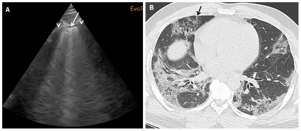 (A)This panel shows a grade 2 LUS image for a 45-year-old man at 10 days from initial symptoms, requiring oxygen (6 l/min), with a severity index of 0.58. On this sagittal ultrasound view encompassing a right anterior inter-rib space (arrows: rib shadows), one can see a typical lung rocket (arrow) as breath moving comet-tail artefact. (B) This panel shows an axial image of the corresponding CT scan performed at admission with typical COVID-19 interstitial pneumonia combining septal thickening (arrow) and peripheral ground glass opacities (stars).