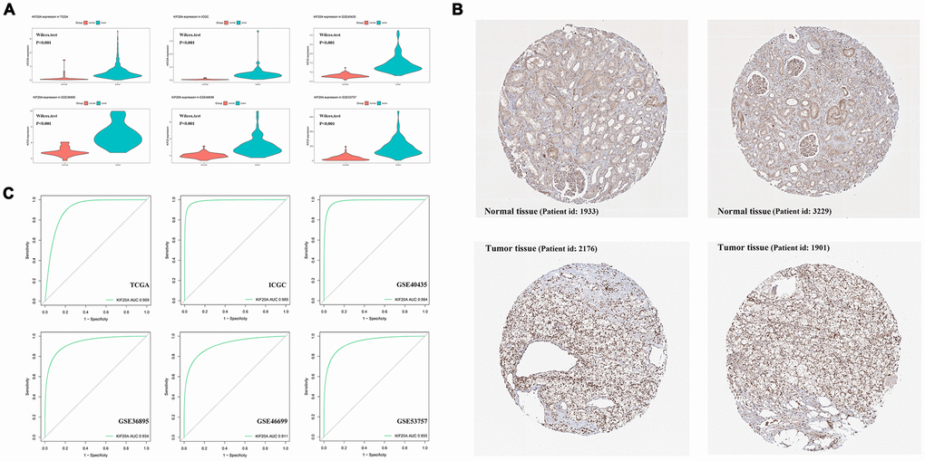 The analysis of KIF20A expression profile. (A) The mRNA expression of KIF20A is up-regulated in TCGA, ICGC, GSE40435, GSE36895, GSE46699 and GSE53757; (B) Representative IHC pictures from HPA database.; (C) ROC curve of KIF20A in predicting tumorigenesis. Abbreviations: TCGA: The Cancer Genome Atlas; ICGC: International Cancer Genome Consortium; IHC: immunohistochemistry; HPA: The Human Protein Atlas project.