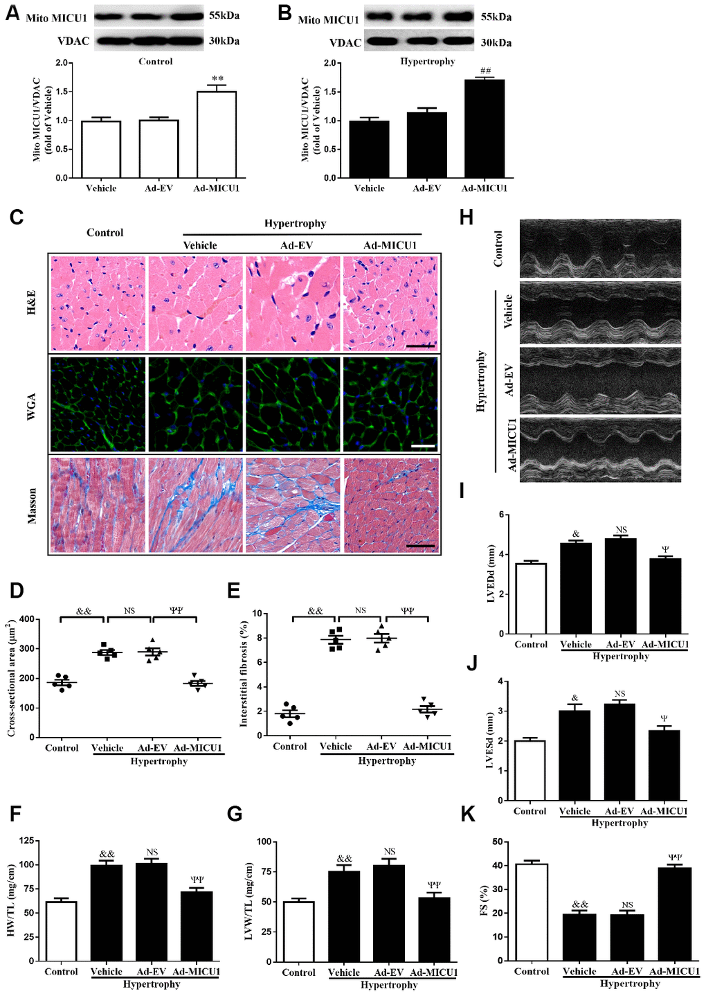 MICU1 overexpression in the heart attenuated cardiac hypertrophy. (A, B) Representative immunoblots and quantification of protein levels of MICU1 in control (A) and hypertrophy hearts (B) infected with Ad-EV and Ad-MICU1 were shown. (C) Histological analyses of heart sections stained with H&E, wheat germ agglutinin, and Masson from the indicated groups were presented. (D) The average cross-sectional area of cardiomyocytes from the indicated groups was summarized. (E) The interstitial fibrosis was quantified. (F, G) The rations of HW/TL (F) and LVW/TL (G) in different mice were determined. (H) Representative echocardiographic image of the left ventricle in different mice was represented. (I–K) Echocardiographic assessment of LVEDd, LVESd and FS was used to reflect cardiac function. Ad-EV, control adenovirus; Ad-MICU1, recombinant adenovirus encoding MICU1. All the data represent the means ± SEM. N=6-8/group. **P##P&P&&PΨPΨΨP