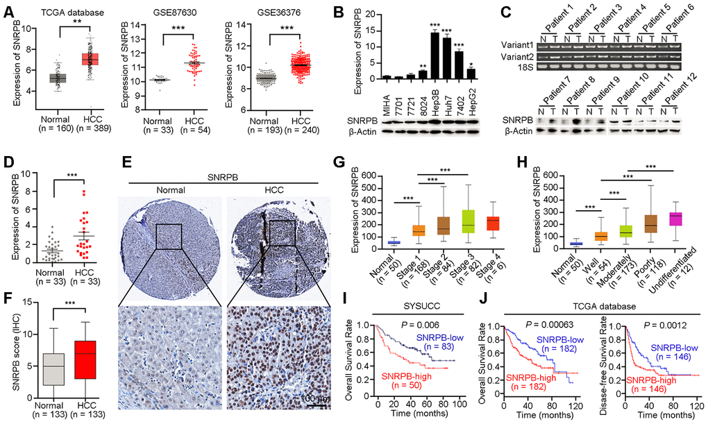 Overexpression of SNRPB predicts poor survival of HCC patients. (A) The expression levels of SNRPB in normal liver tissues and HCC tissues were analyzed based on TCGA database and GEO datasets (GSE87630 and GSE36376). (B) Real-time quantitative PCR (qRT-PCR, upper panel) and western blotting (lower panel) were used to examine the expression of SNRPB in HCC cell lines and immortalized hepatocytes (MIHA). 18S or β-Actin served as the loading controls. (C) The expression levels of SNRPB in paired HCC tumor (T) and normal liver (N) tissues were examined by RT-PCR (upper panel) and western blotting (lower panel). Two splicing variants of SNRPB were analyzed by RT-PCR, and 18S served as the loading control. (D) qRT-PCR was used to examine the expression levels of SNRPB in HCC tissues and the corresponding normal liver tissues (n = 33). (E) Representative images of IHC staining of SNRPB in paired normal liver and HCC tissues. (F) IHC staining scores of SNRPB in HCC tissues and the corresponding normal liver tissues (n = 133). (G, H) SNRPB expression is related to HCC cancer stages (G) and differentiation grades (H) in TCGA database. (I, J) Kaplan–Meier survival curves showed that SNRPB expression level was negatively correlated with HCC prognosis, as analyzed by HCC tissue microarray (I) and TCGA database (J). In all panels, **P P 