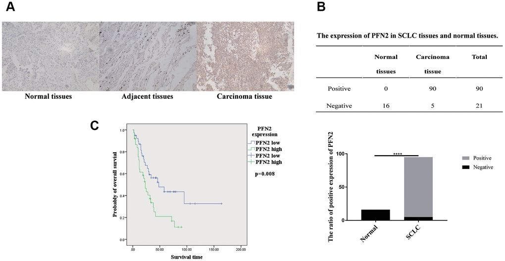 PFN2 detected in SCLC tissue and normal lung tissue. IHC results showing PFN2 expression in SCLC tissues but not in the healthy lung and adjacent tissues (A). The ratio of PFN2 expression is dramatically higher in SCLC tissue than in normal lung tissue (P=0.0000) (B). Kaplan-Meier survival analysis reveals that PFN2 expression is inversely correlated with the survival time in patients with SCLC (C).