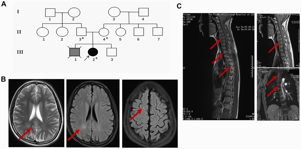 Clinical data of the proband. (A) Pedigree of the family presenting the p.Leu439Pro mutation. Circles and squares represent females and males, respectively. Clear symbols represent the healthy subject, the grey filled symbol with a cross indicates the deceased subject without clinical diagnosis or genetic examination, and the black filled symbol represents the proband. The asterisk was labeled to the individuals who received the MTHFR exon sequencing. (B) Representative brain MRI scan images in the basilar ganglia (left and middle panel) and centrum semiovale (right panel) in T2 and FLAIR sequence of the proband. Arrows indicate the white matter injury in the occipital lobe and parietal lobe. (C) Representative cervicothoracic combined MRI (left panel) slides of the proband to show the sever reverse gantry of the cervical spine (right upper panel) and scoliosis of the thoracic spine (right lower panel).