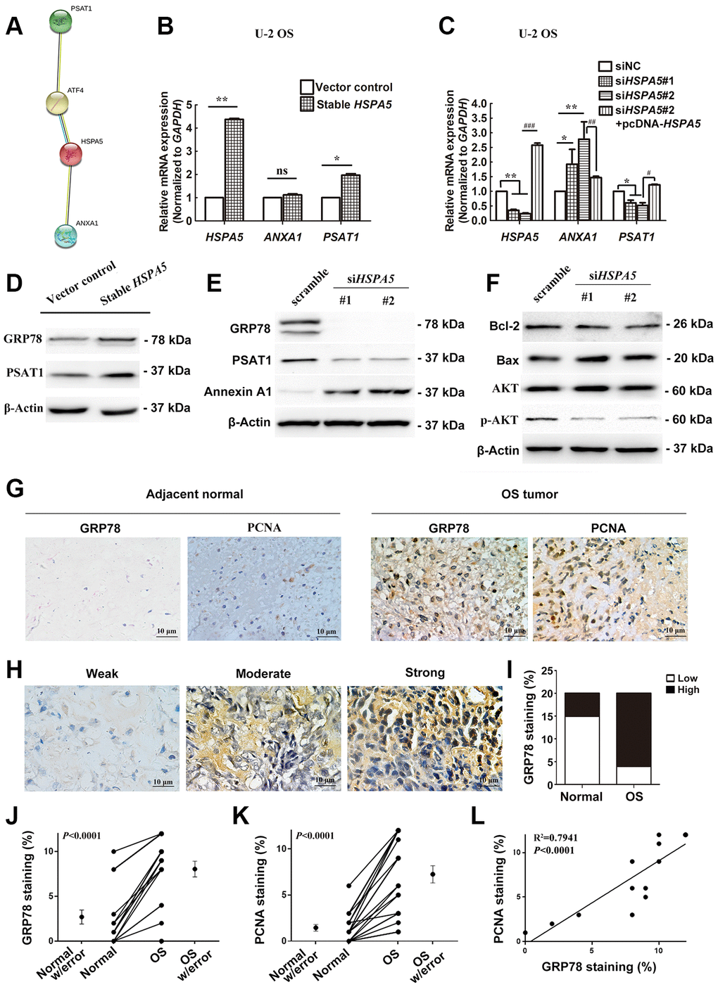 A dual role of HSPA5 in transcriptional mediation of ANXA1 and PSAT1 and its correlation with the clinicopathological features of OS. (A) PPI network of proteins GRP78 (HSPA5), Annexin A1 and PSAT1. (B) The gene regulation of ANXA1 and PSAT1 in stable HSPA5-expressing U-2 OS cells. (C) The expression of the indicated genes in HSPA5-siRNAs and HSPA5-rescued plasmid-transfected U-2 OS cells. (D) Stable HSPA5-expressing or the empty U-2 OS cells were subjected to immunoblotting analysis of PSAT1 and GRP78 levels. *P P E, F) The expression levels of (E) Annexin A1 and PSAT1 and (F) molecules involved in AKT pathway and apoptotic pathway in HSPA5 siRNAs-transfected U-2 OS cells. (G) Expression of GRP78 and PCNA were detected by immunohistochemical staining in indicated adjacent normal tissues and tumors from OS patients. (H) Images of immunohistochemical staining for protein GRP78 in OS tissues of representative patients. (I) GRP78 expression increased progressively with aggressive progression of OS tissues with P-value less than 0.05. (J, K) IHC staining quantification of GRP78 and PCNA in the matched OS and adjacent normal tissues (n = 11 and 15, respectively). (L) The correlation of GRP78 and PCNA staining in OS tissues (n = 12). All data are shown with mean ± SD.*or #P ##P ###P 