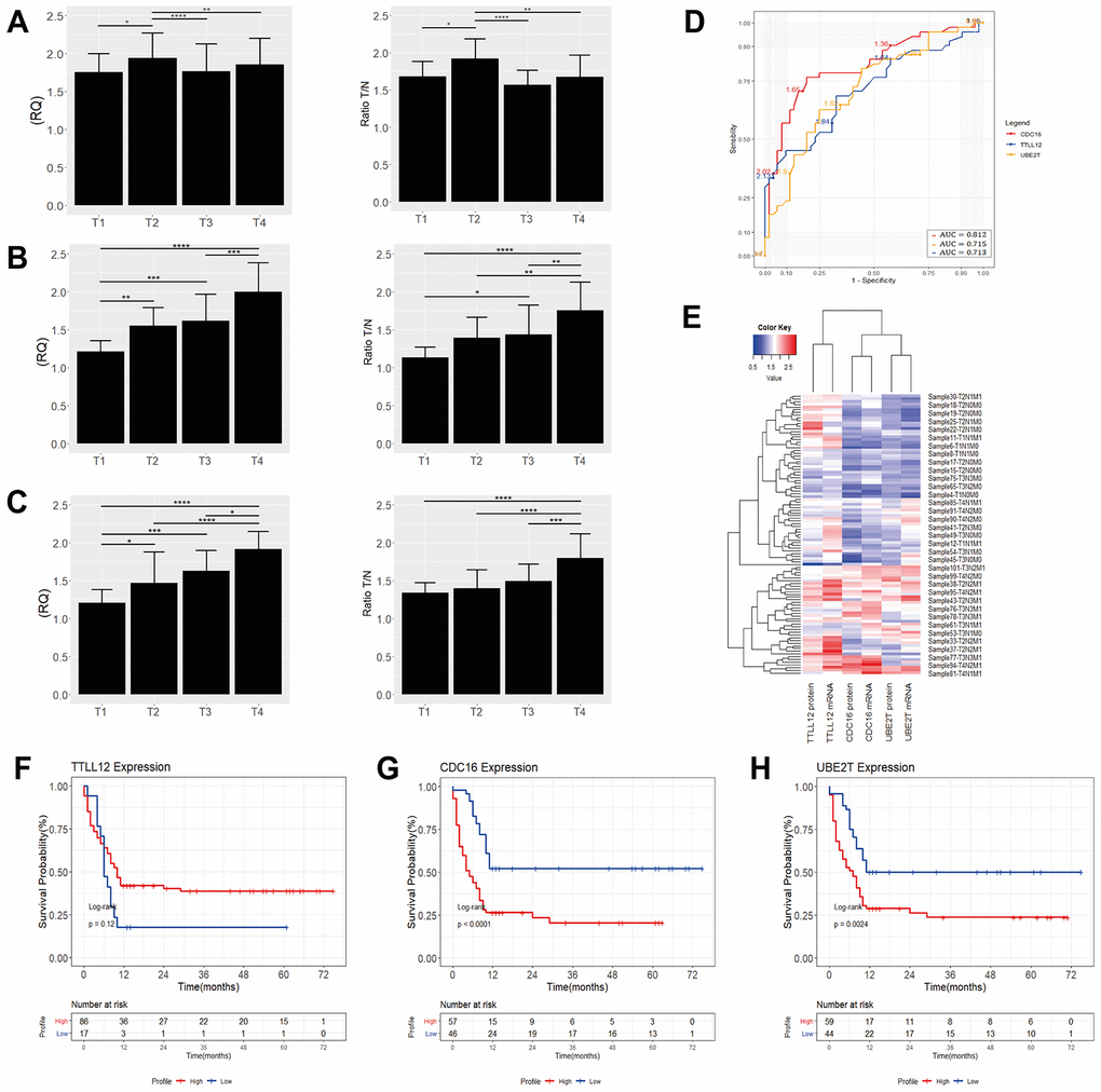 Quantification of TTLL12 (A), CDC16 (B) and UBE2T (C) mRNA and protein levels by tumor stage in GC of the diffuse-type. *p p p p D) ROC curve analysis. The cutoff point was chosen as the highest point of the Area-Under-the-Curve (AUC) for TTLL12, AUC: 0.713; (95% CI 0.62-0.76) with 76.02% sensitivity and 50.04% specificity, for CDC16, AUC: 0.812; (95% CI 0.70-0.83) with 85.0% sensitivity and 50.08% specificity and for UBE2T, AUC: 0.715; (95% CI 0.63-0.77) with 77.06% sensitivity and 48.03% specificity. (E) Heat maps showing the average levels of gene expression of ~35 samples of GC tissues of the diffuse-type. The red gradient shows the highest levels of expression while the blue gradient shows the lowest levels. Kaplan-Meier analysis of the overall survival (in months) of patients with diffuse gastric cancer as a function of (F) TTLL12, (G) CDC16 and (H) UBE2T expression. We analyzed high expression (gene expression ≥1.5; red line), as opposed to low expression (gene expression CDC16 (p UBE2T (p = 0.0024), with patients who had a shorter survival.