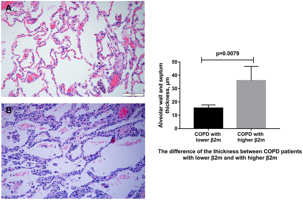 HE staining of lung tissue from COPD patients. (A) Representative image of HE staining of lung tissue from COPD patients with lower serum β2M. (B) Representative image of HE staining of lung tissue from COPD patients with higher serum β2M. The right panel shows difference of alveolar wall/septum thickness in COPD patients with lower serum β2M and with higher serum β2M. P