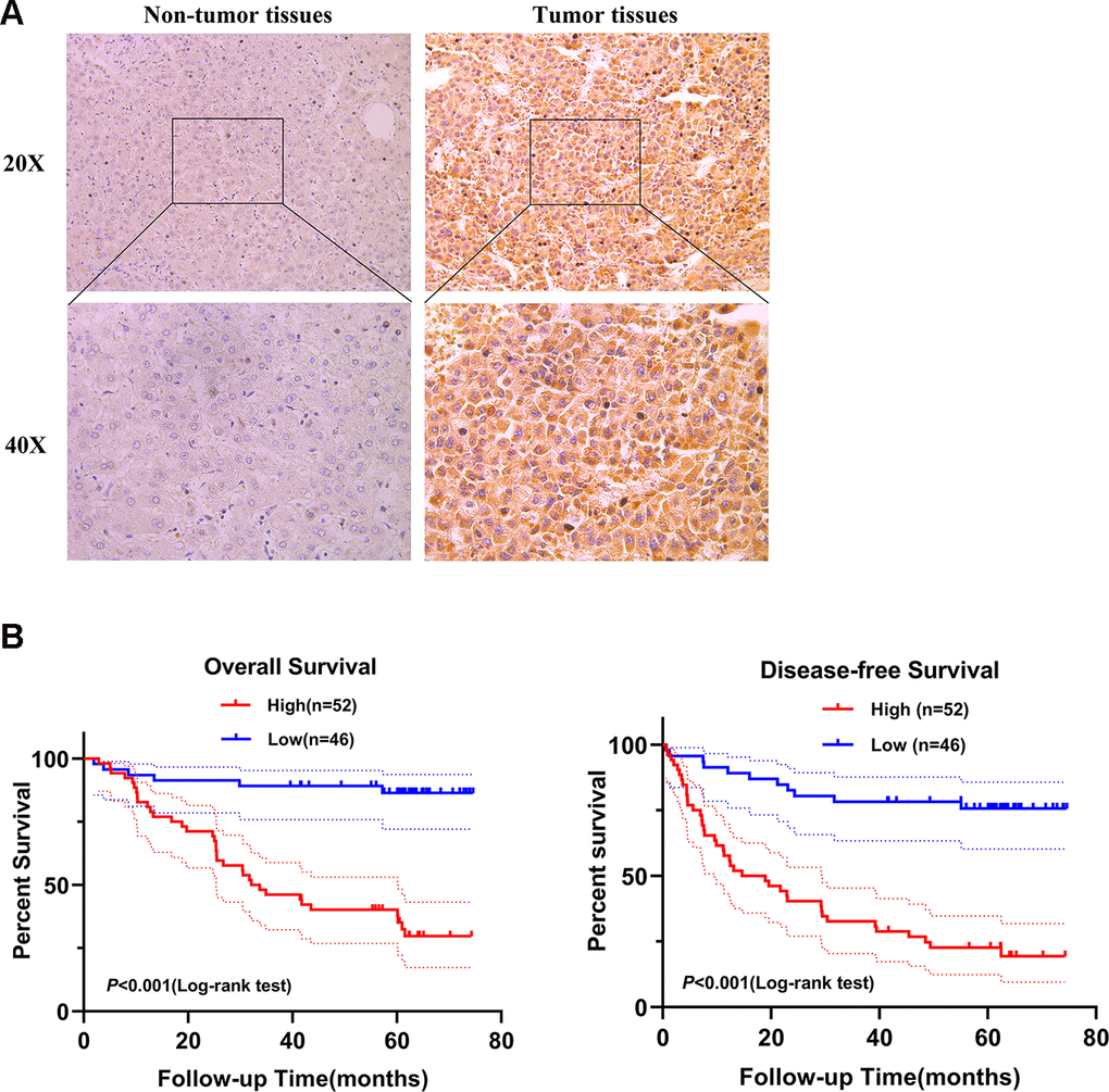 SPATS2 is upregulated in HCC primary tumor tissues and correlates with poorer prognosis. (A) Representatives of SPATS2 staining in a pair of tumor tissue and adjacent non-tumor tissue. The boxed regions are amplified as images below. (B) Kaplan-Meier plots of overall survival and disease-free survival.