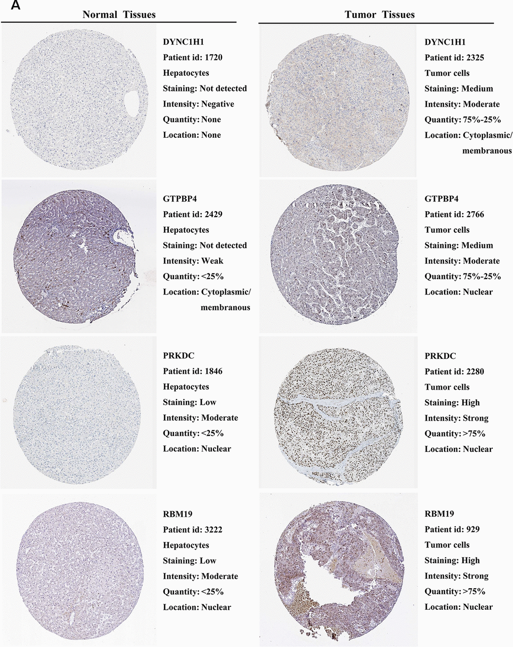 Validation of prognostic RBP expression in the HPA database. (A) Representative immunohistochemical staining of HCC primary tumor tissues and normal liver tissues.