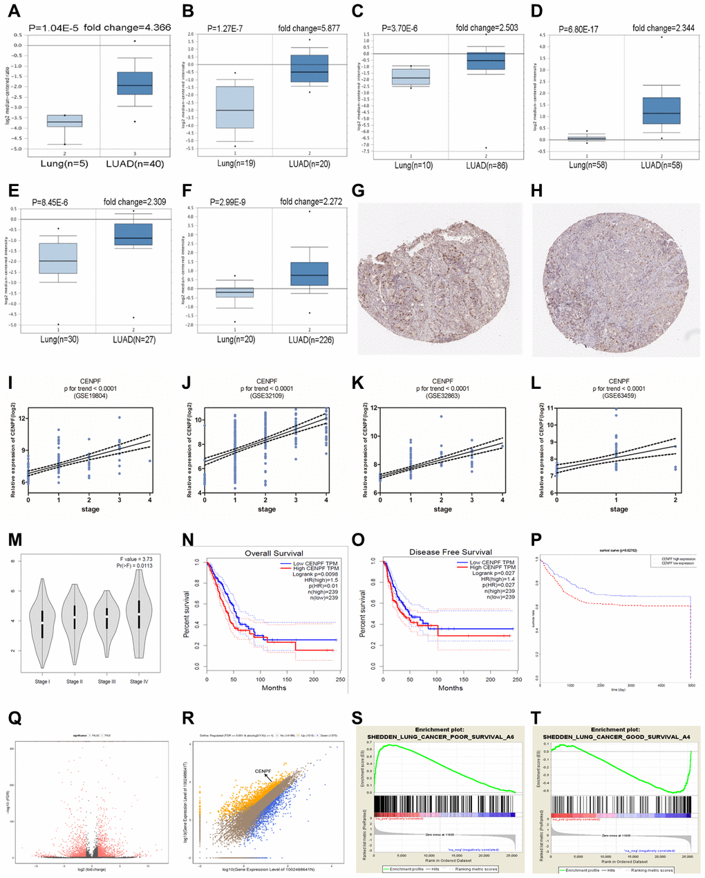 CENPF is upregulated in LUAD and is related with TNM staging and prognosis of LUAD patients. (A–F) Oncomine database results show that CENPF expression is significantly up-regulated in LUAD. (The corresponding P value and fold change are given above the picture). (G, H) The Human Protein Atlas database indicates that CENPF is strongly expressed in LUAD. G: LUAD (patient ID.4923, male, 57); H: normal lung tissue (patient ID. 4208, male, 75). (I–L) Analyzes the relationship between CENPF and LUAD staging based on four datasets. (M) Verify the correlation between the expression of CENPF and the pathological stage of LUAD (based on TCGA data in GEPIA). N-P: Survival analysis. (N, O) Kaplan Meier curves of OS (overall survival), DFS (Disease-free survival) in a cohort of LUAD stratified by CENPF expression. (P) Survival curves of CENPF gene in LUAD patients based on TCGA database. (Q) RNA sequencing analysis of volcano maps. (R) RNA sequencing results indicate that CENPF is highly expressed in LUAD tissues. Orange represents a high expression of the gene in LUAD, and blue represents a low expression of the gene in LUAD. (S, T) The CENPF gene was analyzed using Gene Set Enrichment Analysis (GSEA). The positive expression of the CENPF is related with a low prognosis in LUAD patients.